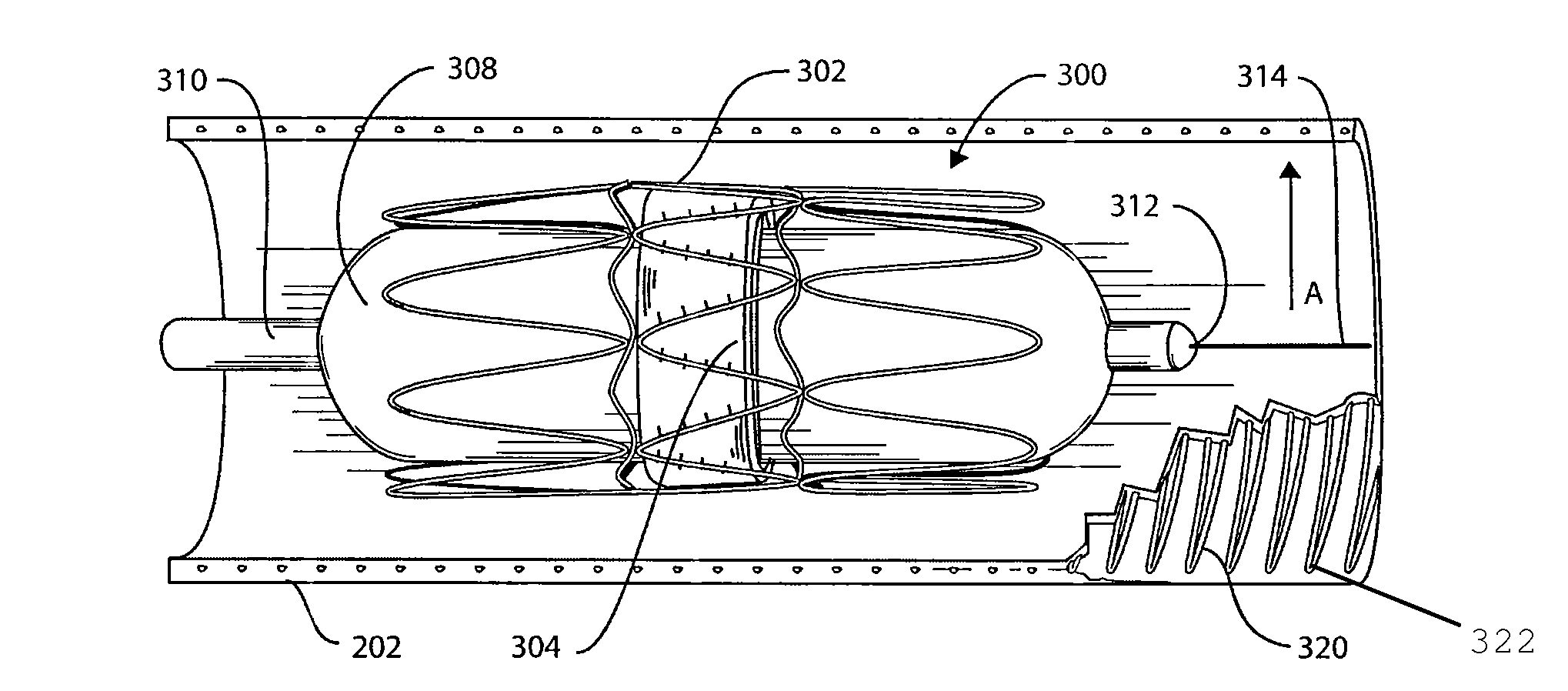 Reinforced surgical conduit for implantation of a stented valve therein