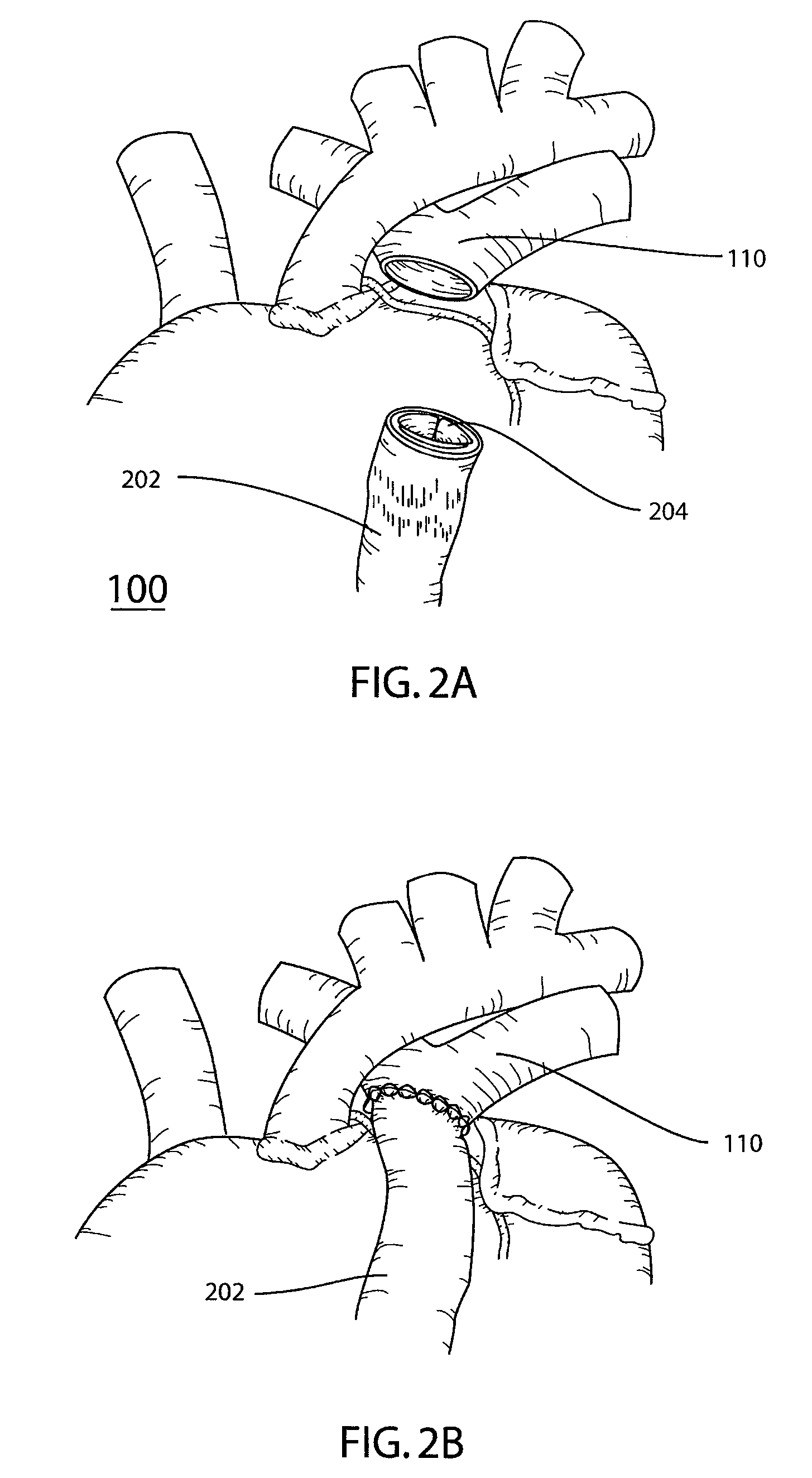 Reinforced surgical conduit for implantation of a stented valve therein