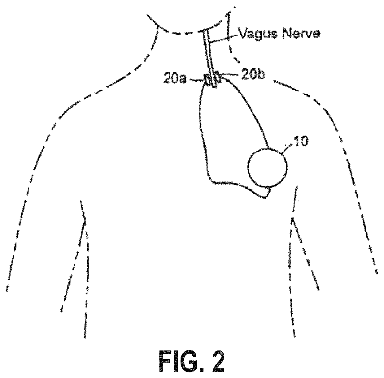 Treating inflammatory disorders by stimulation of the cholinergic Anti-inflammatory pathway