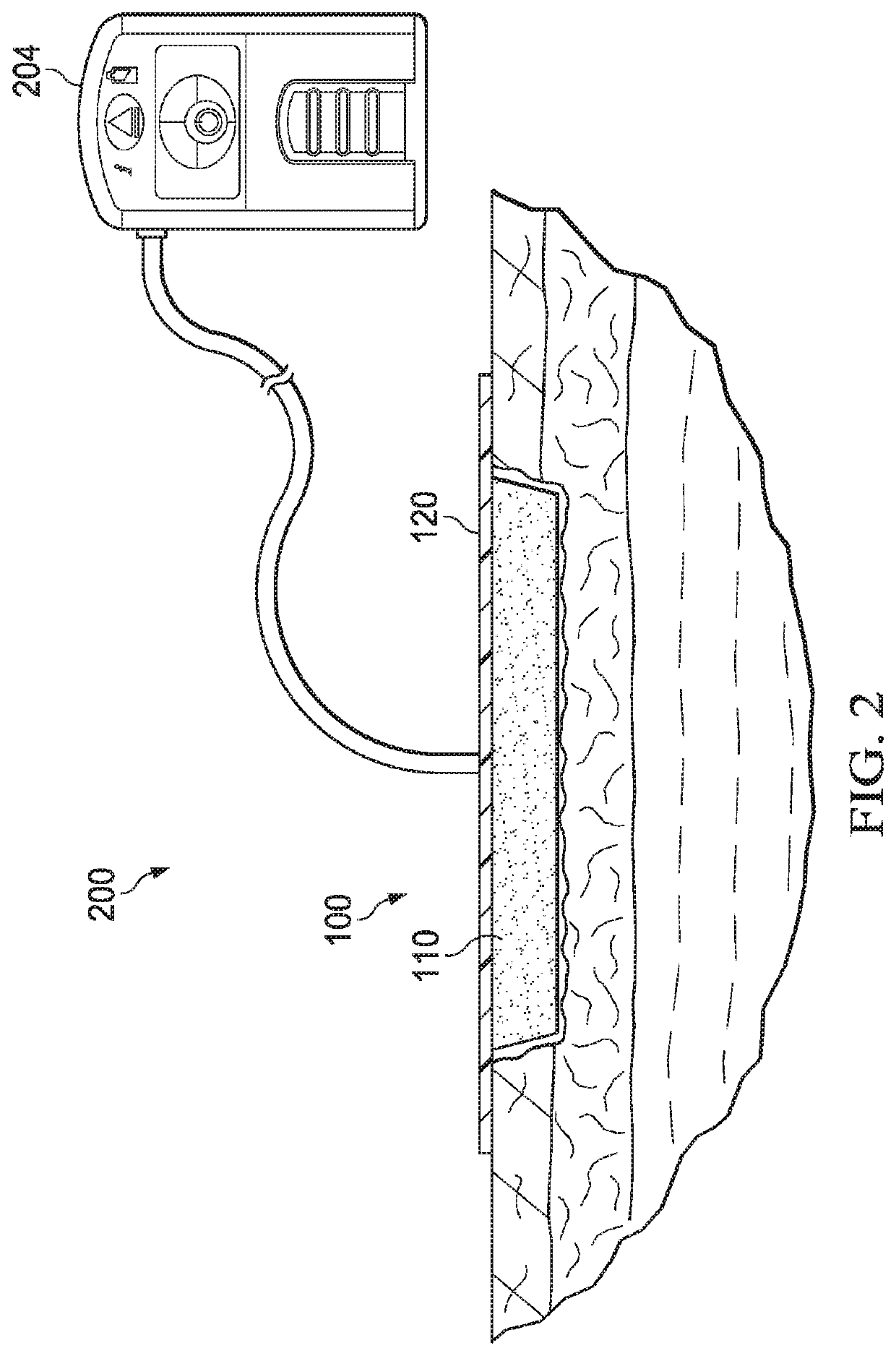 Elastically deformable wound dressings