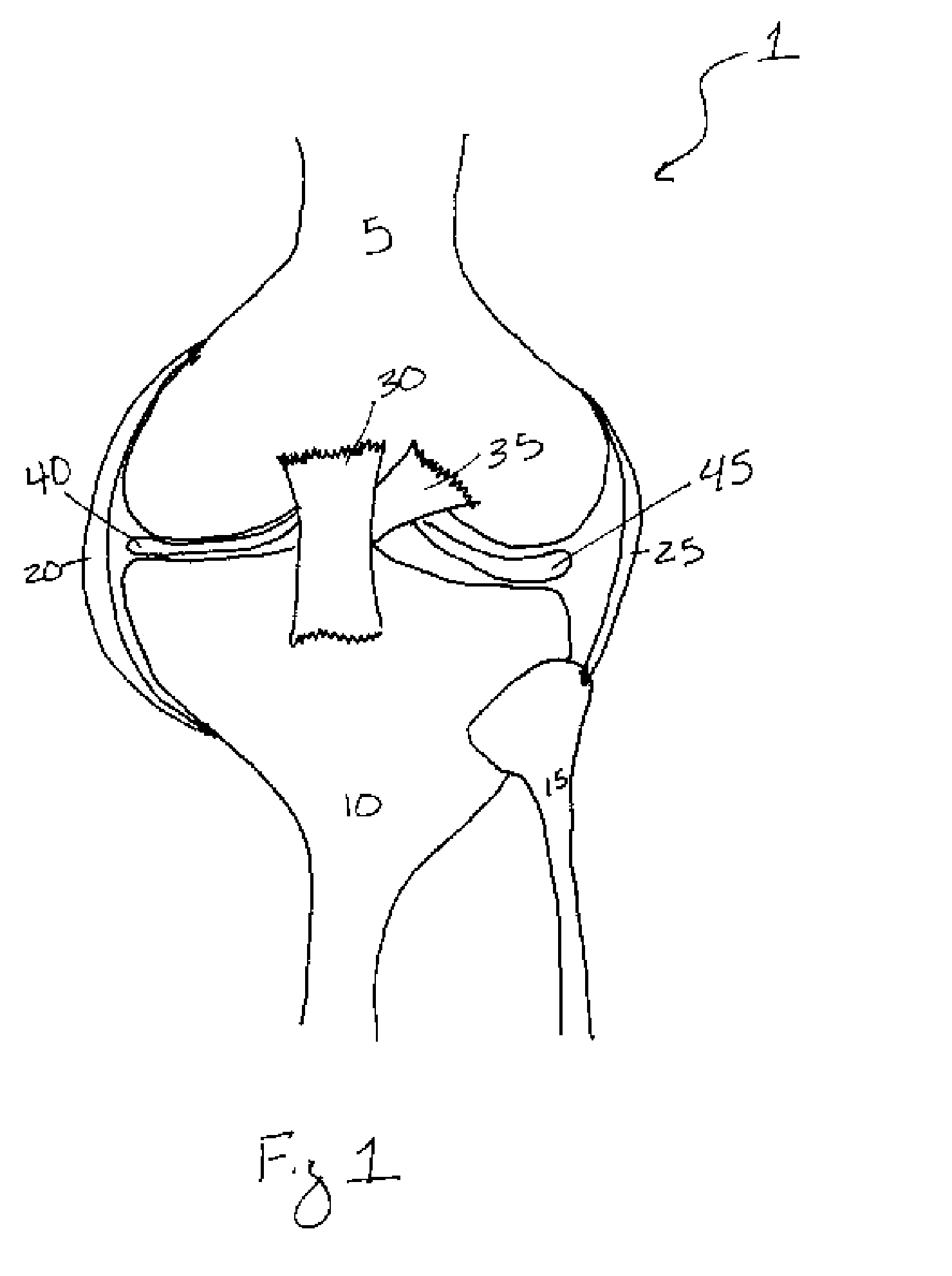 Methods of treating a trauma or disorder of the knee joint by local administration and sustained-delivery of a biological agent
