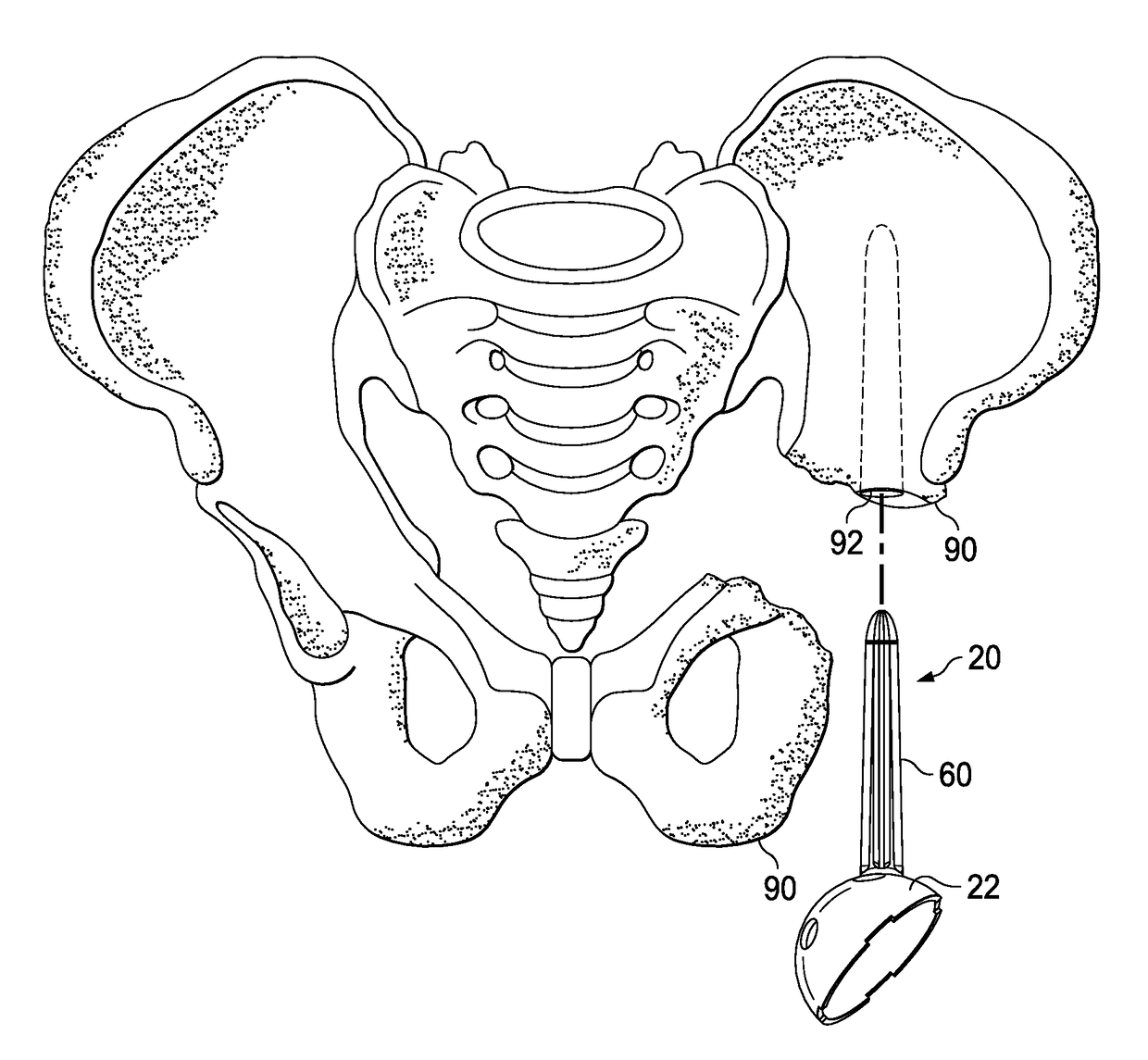 Acetabular surgical implant for segmental pelvic defect and methods of use and manufacture