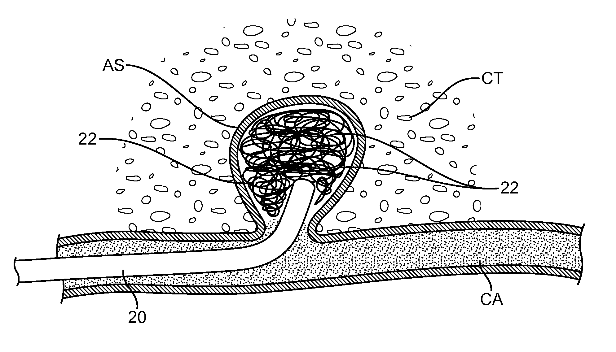 System and method for treatment of hemorrhagic stroke