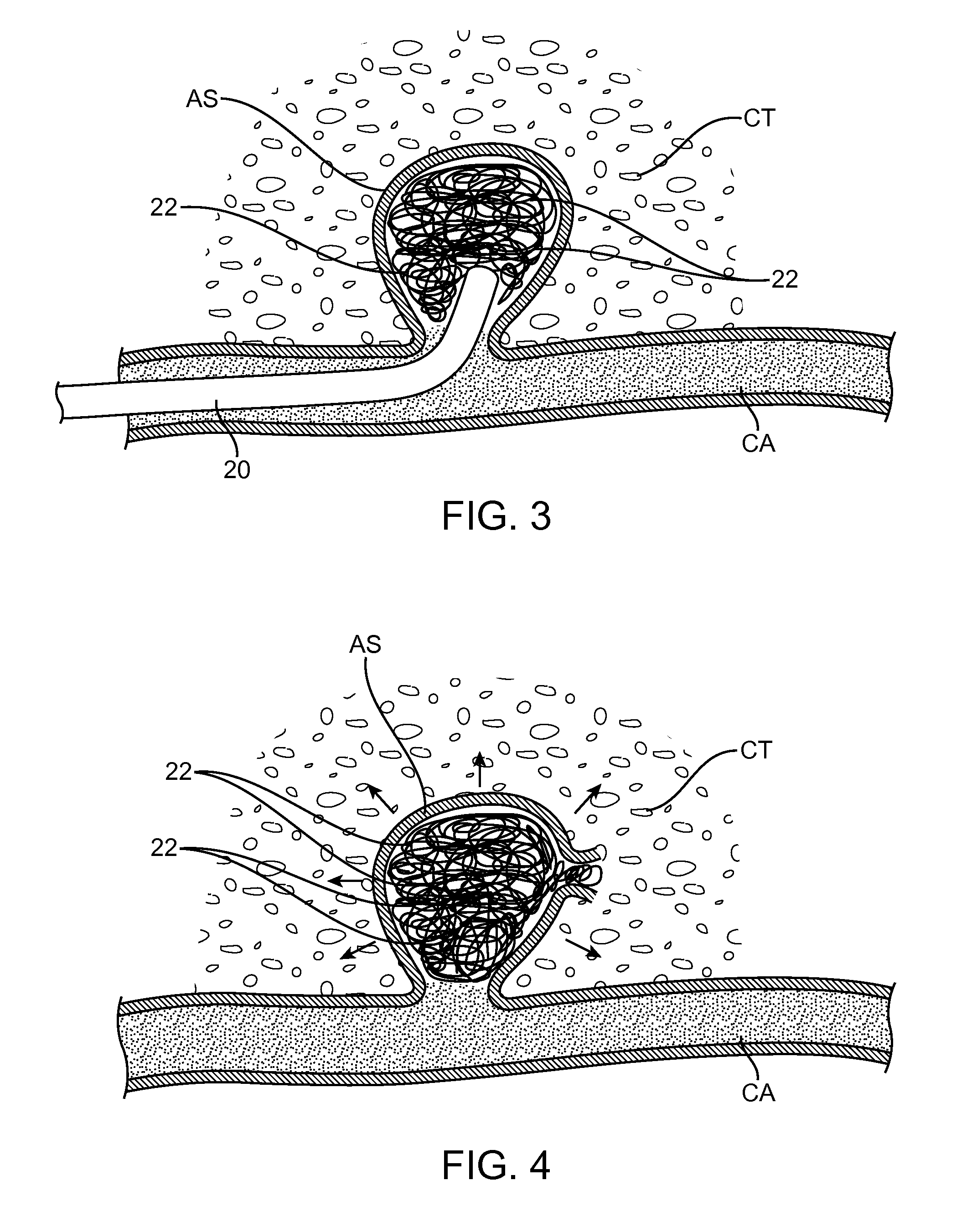 System and method for treatment of hemorrhagic stroke