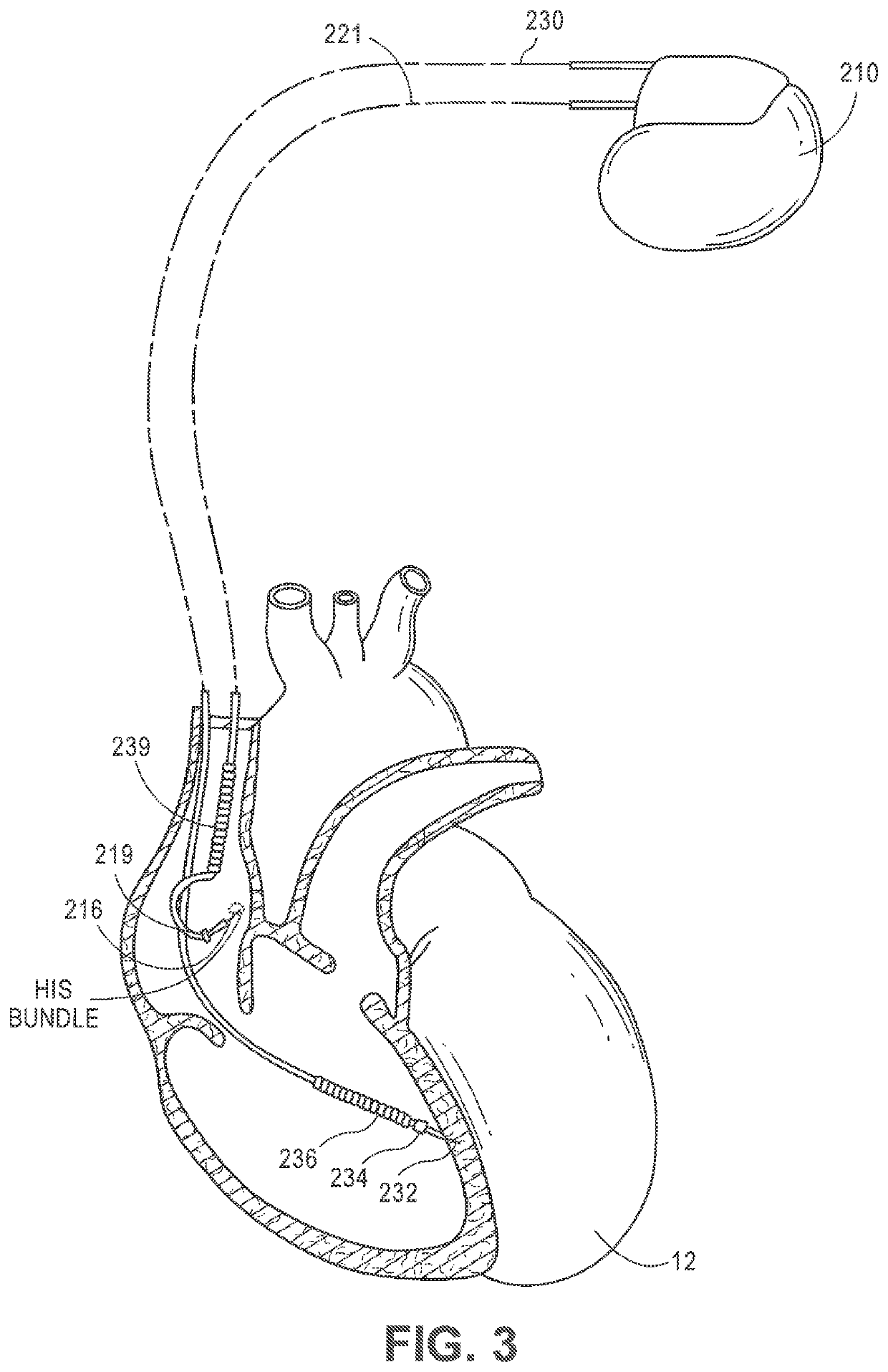 Systems and methods for automated capture threshold testing and associated his bundle pacing