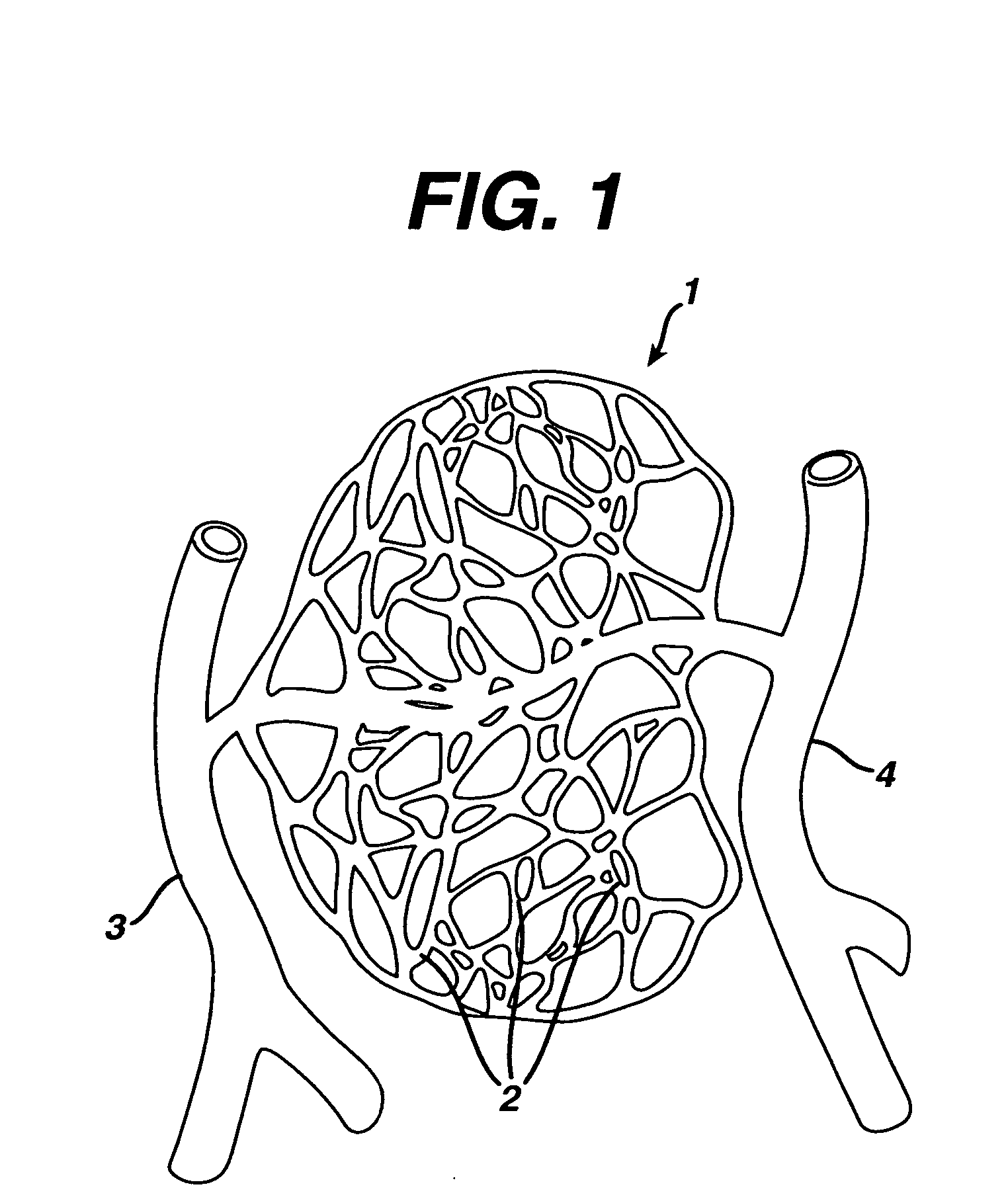Systems and methods for occluding a blood vessel