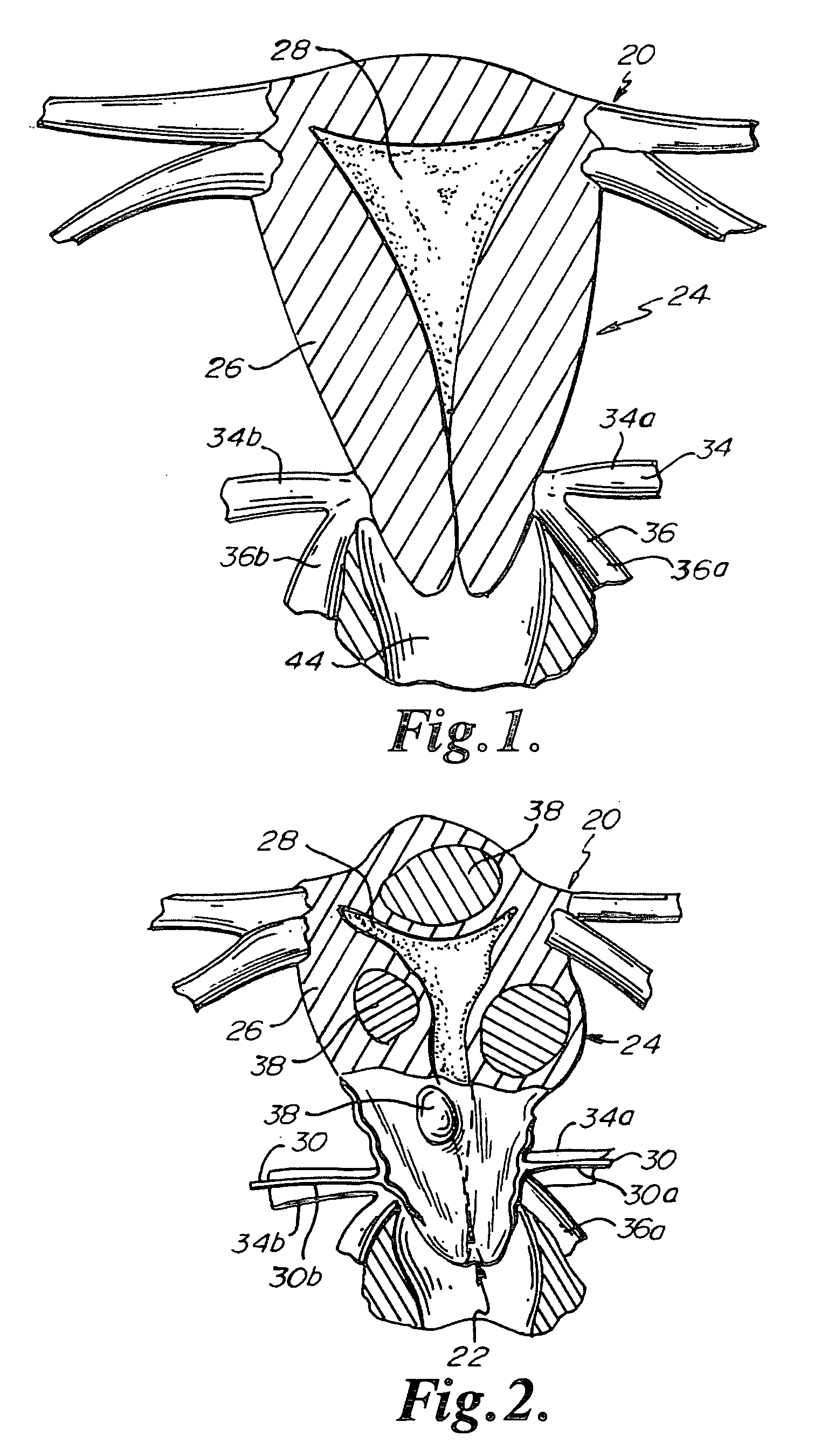 Uterine Artery Ligation Devices and Methods