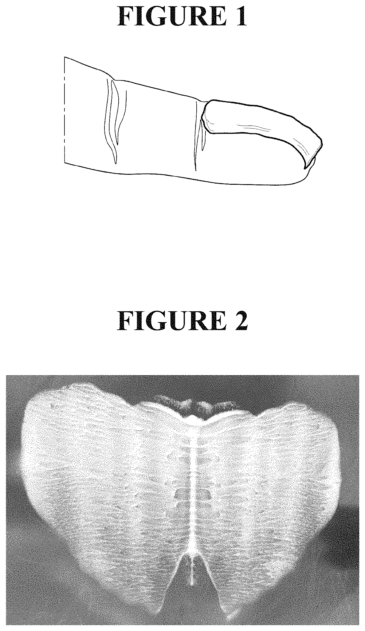 Topical phenytoin for use in the treatment of peripheral neuropathic pain