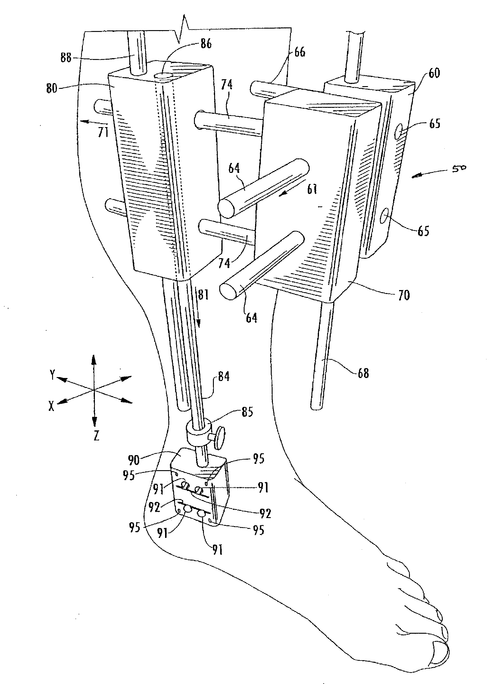 Method of Preparing an Ankle Joint for Replacement, Joint Prosthesis, and Cutting Alignment Apparatus for Use in Performing an Arthroplasty Procedure