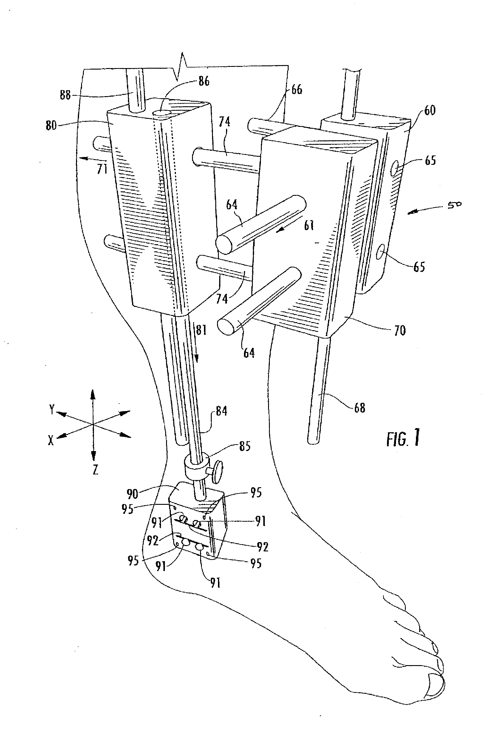 Method of Preparing an Ankle Joint for Replacement, Joint Prosthesis, and Cutting Alignment Apparatus for Use in Performing an Arthroplasty Procedure