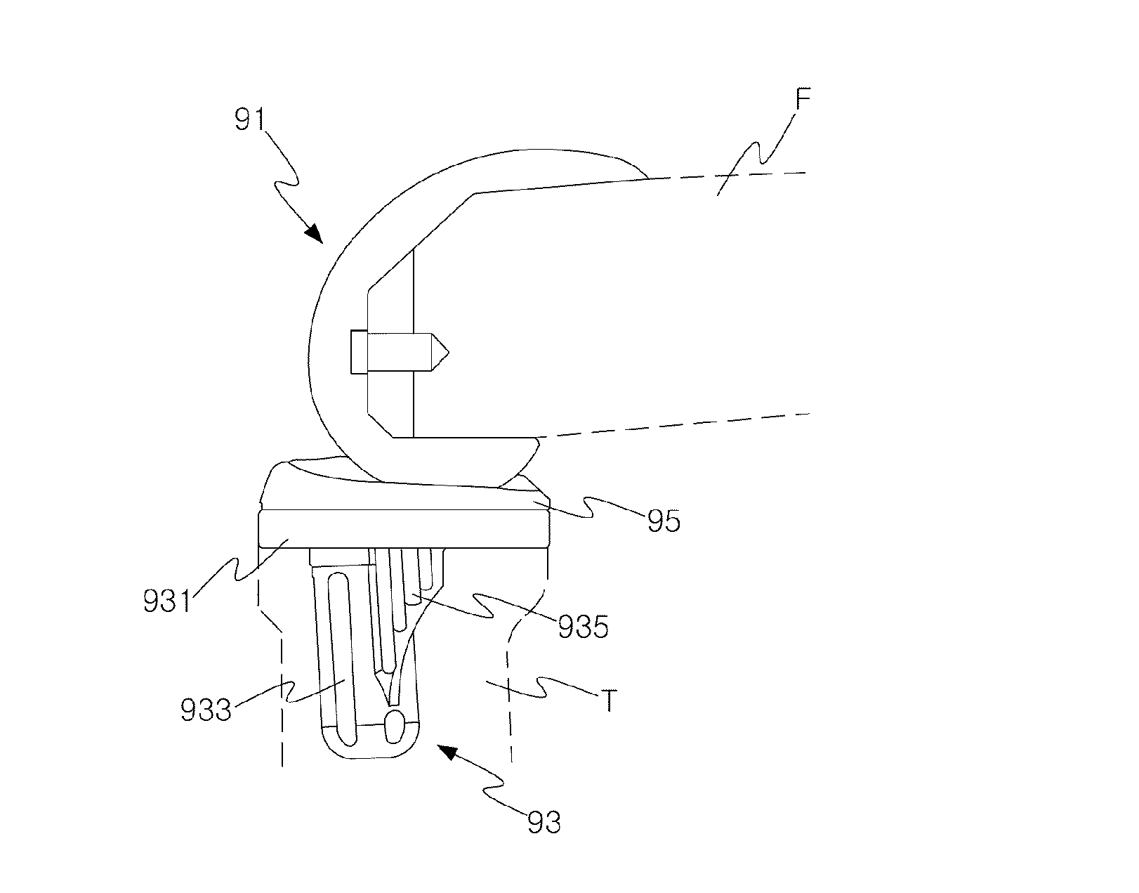 Method of Manufacturing Patient-Customized Tibial Element