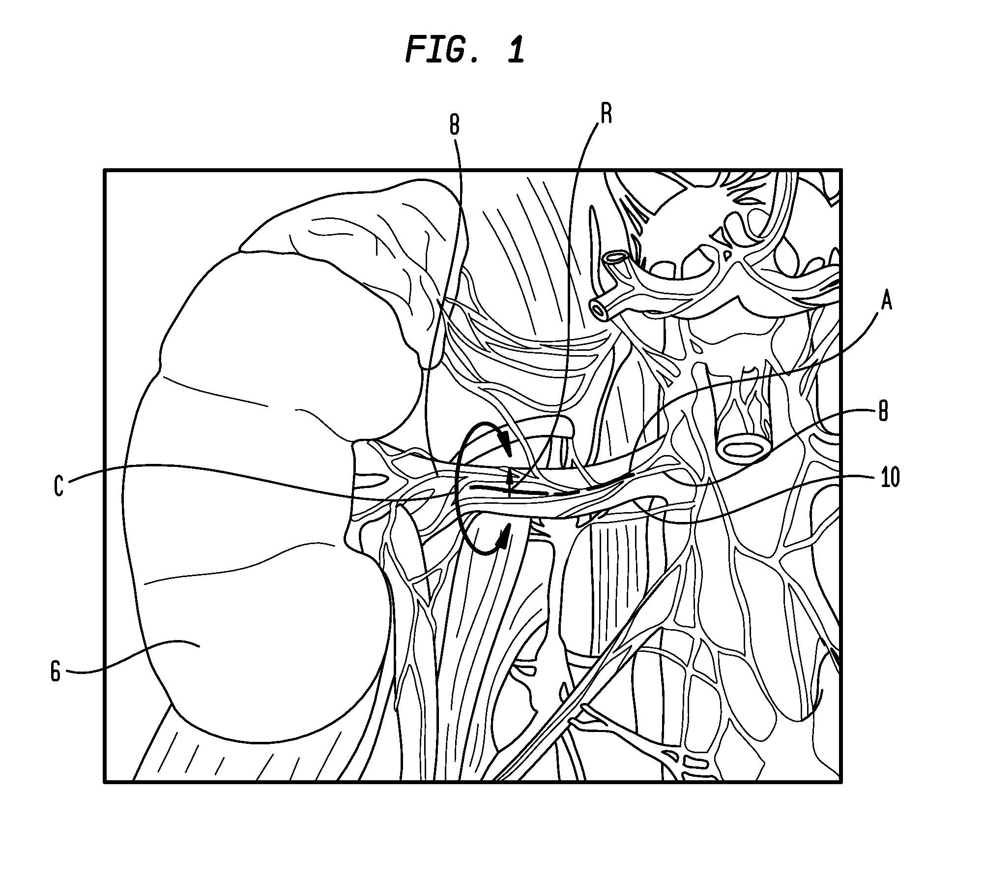Method and Apparatus for Treatment of Hypertension Through Percutaneous Ultrasound Renal Denervation