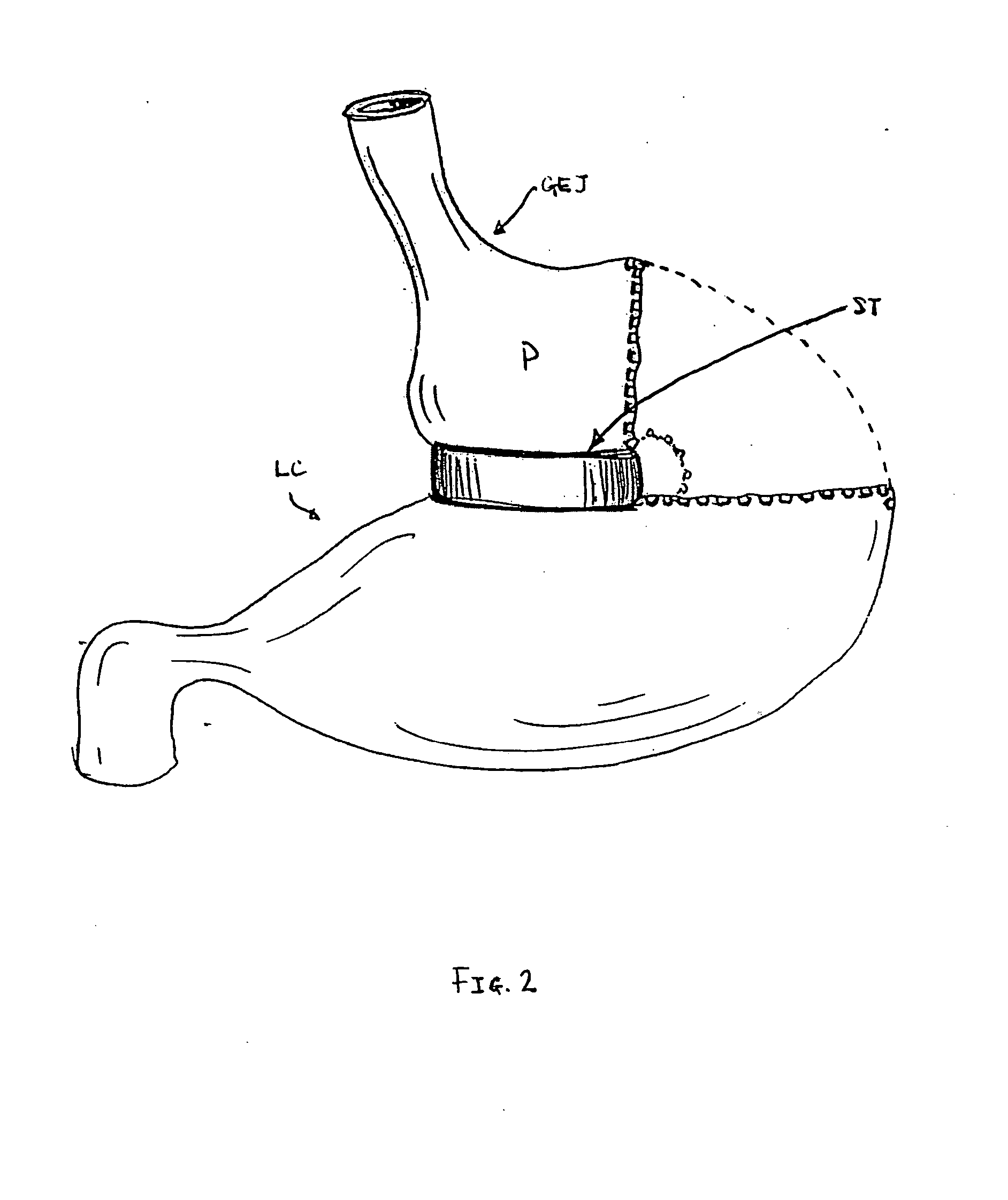 Method and device for use in endoscopic organ procedures