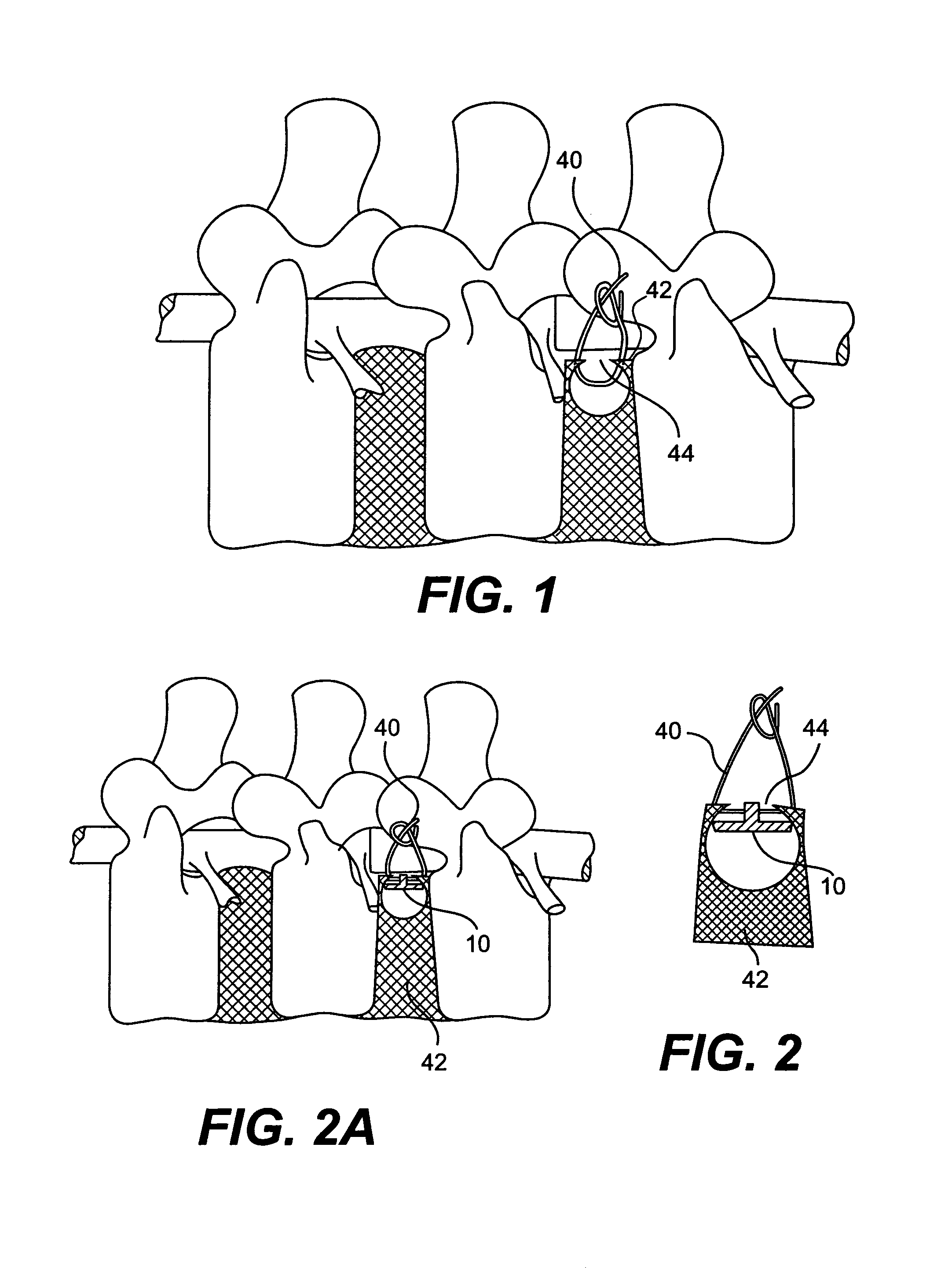 Method and apparatus for enhanced delivery of treatment device to the intervertebral disc annulus