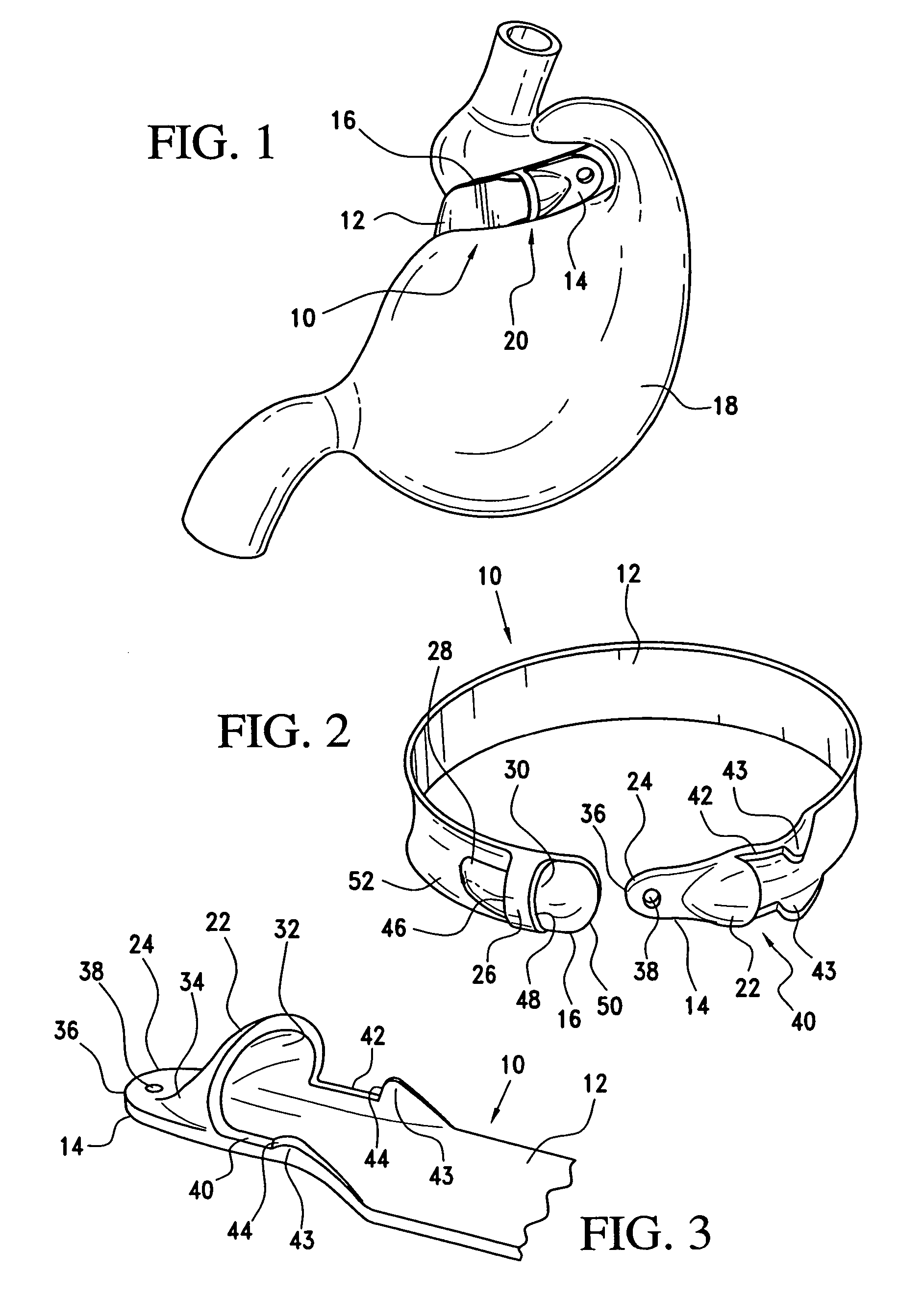 Latching device for gastric band