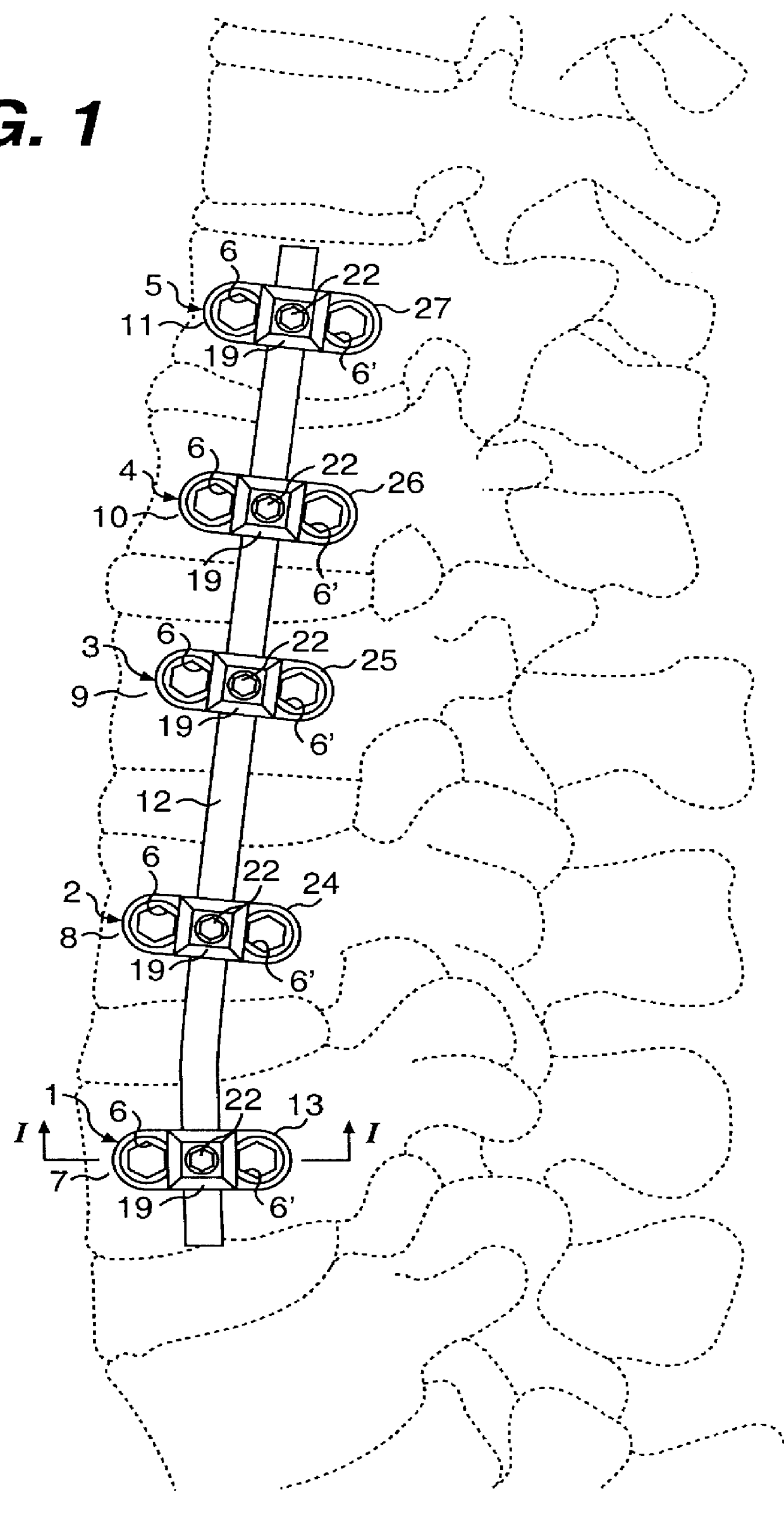 Device and method for correcting and stabilizing a deviating curvature of a spinal column
