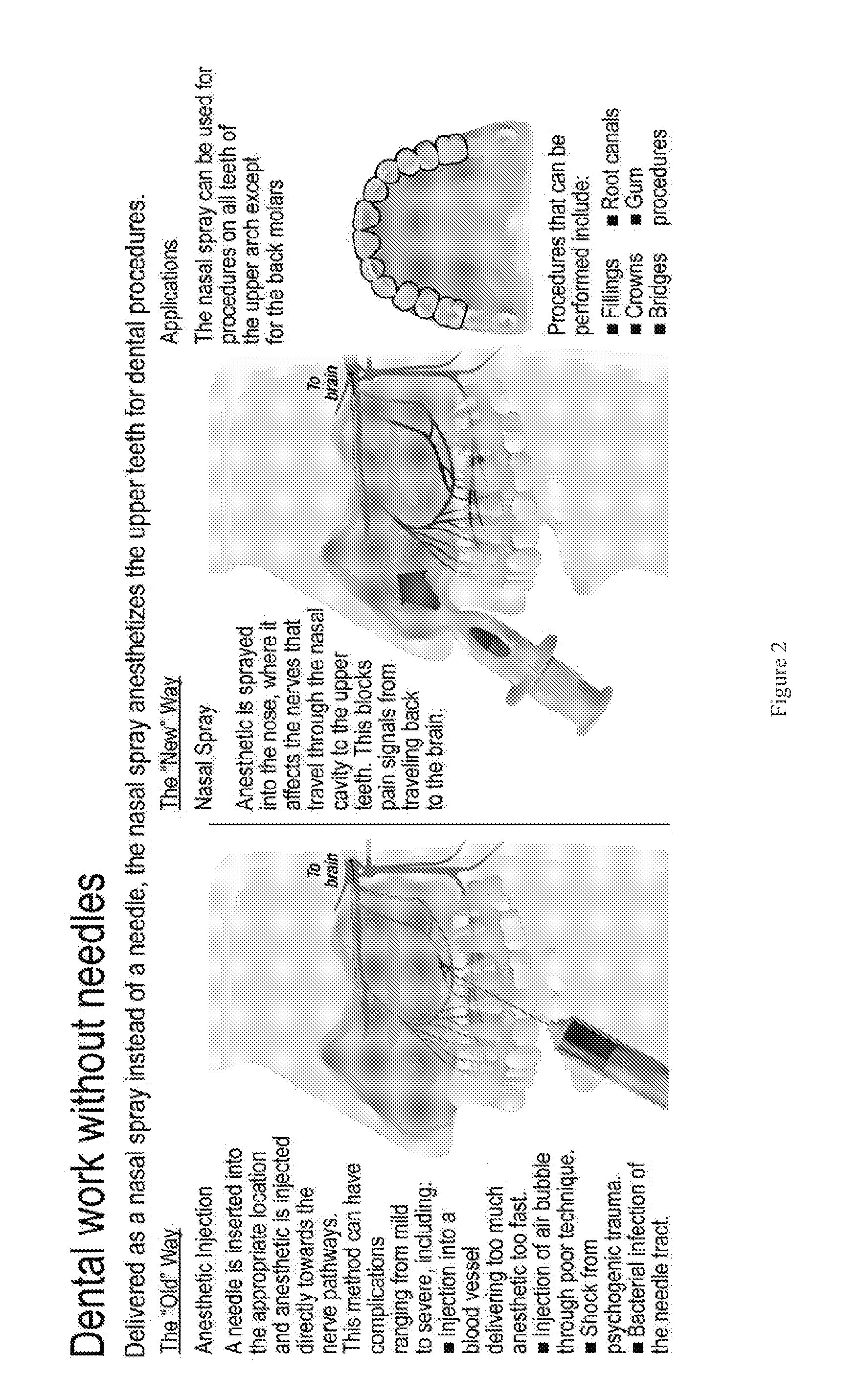 Dental anesthetic comprising tetracaine and a vasoconstrictor for intranasal administration