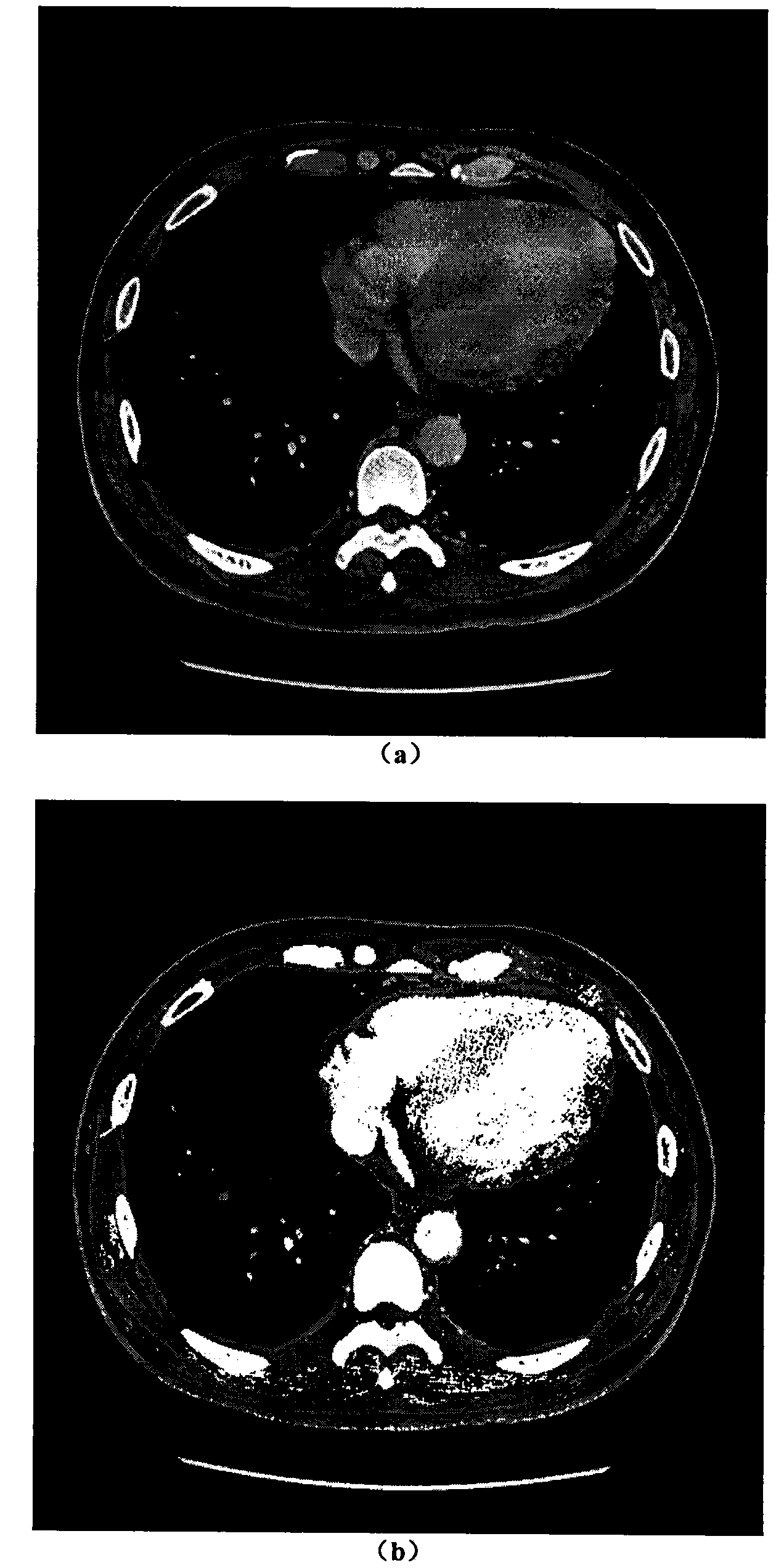 Medical image segmentation method based on quantum-behaved particle swarm cooperative optimization