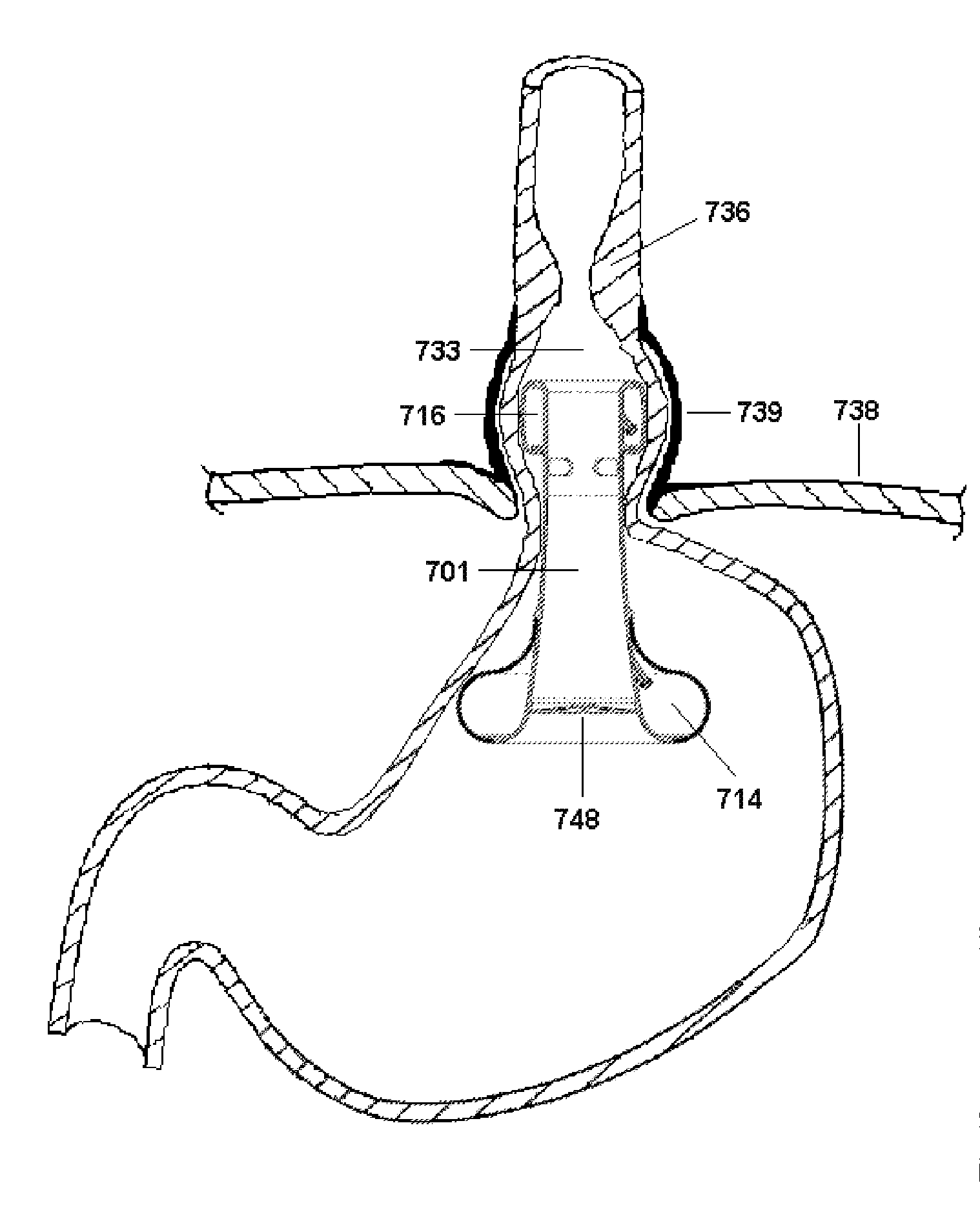 Anti-reflux devices and methods for treating gastro-esophageal reflux disease (GERD)