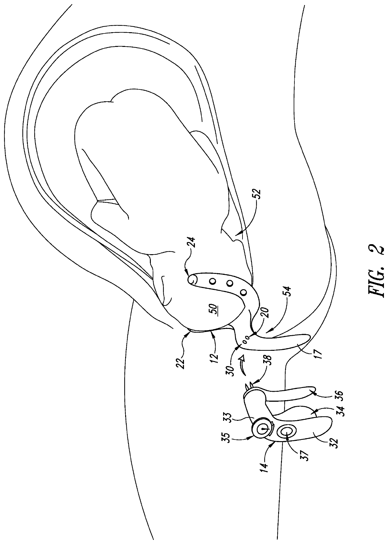 Method of protecting the pelvic floor during vaginal childbirth