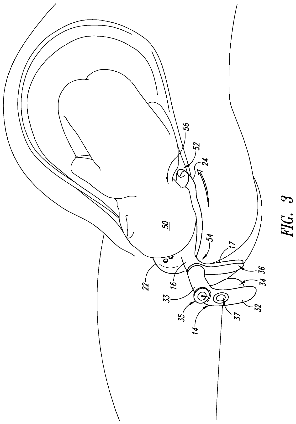 Method of protecting the pelvic floor during vaginal childbirth