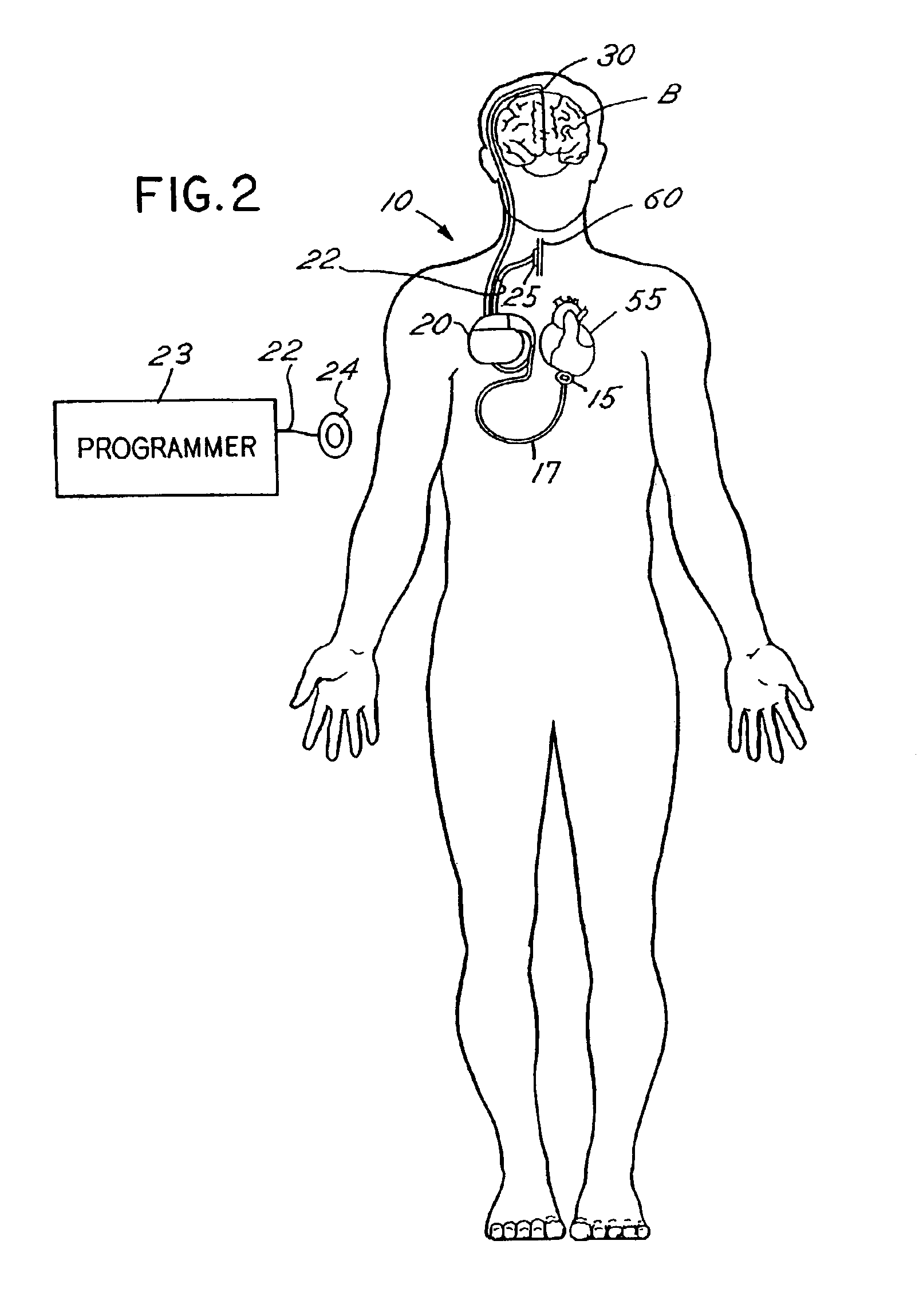Vagal nerve stimulation techniques for treatment of epileptic seizures