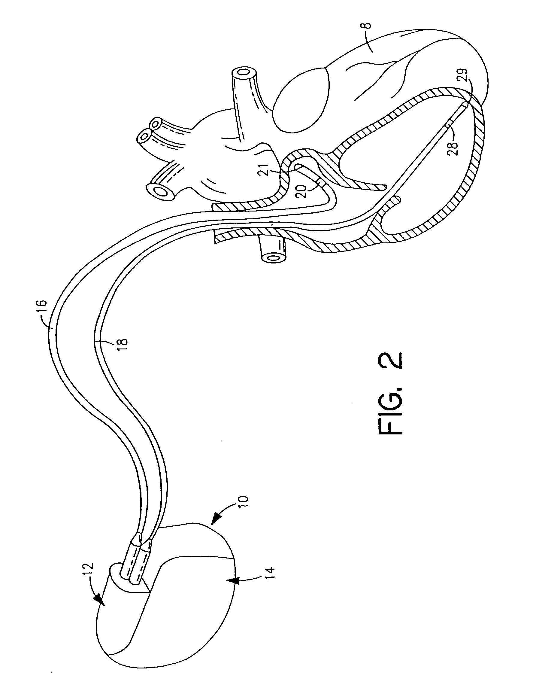 System and method for remote programming of an implantable medical device