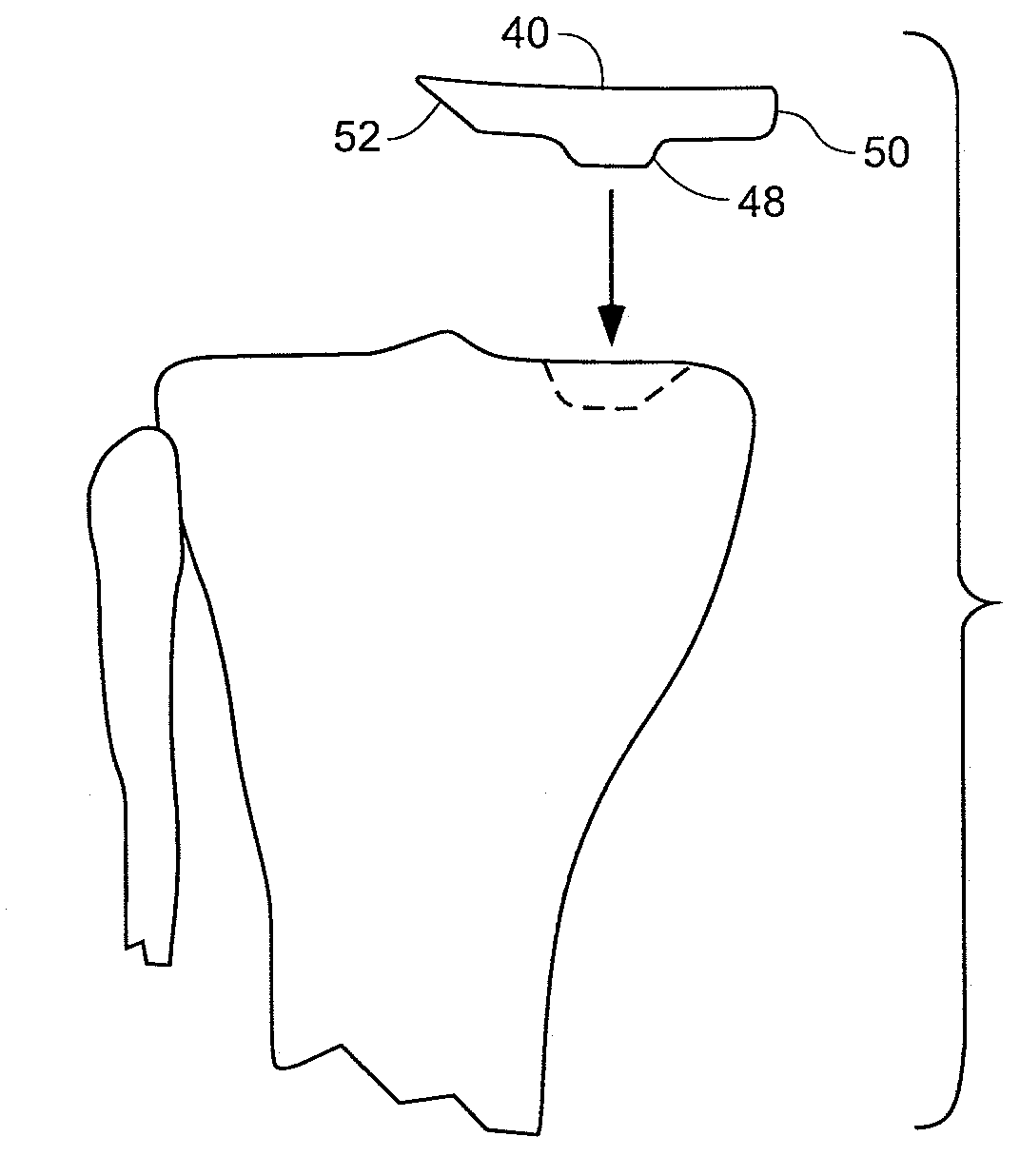 Method and system for mammalian joint resurfacing