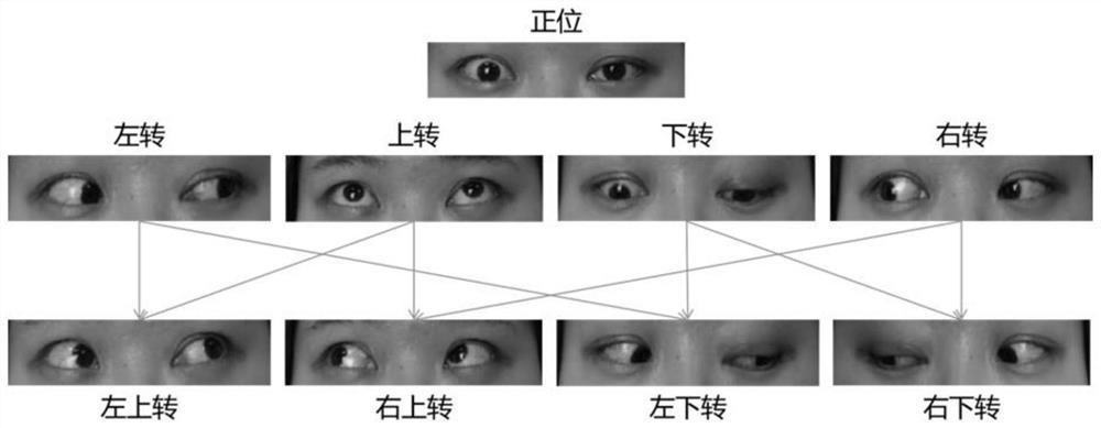 Eye sign recognition method and device for thyroid-related eye diseases
