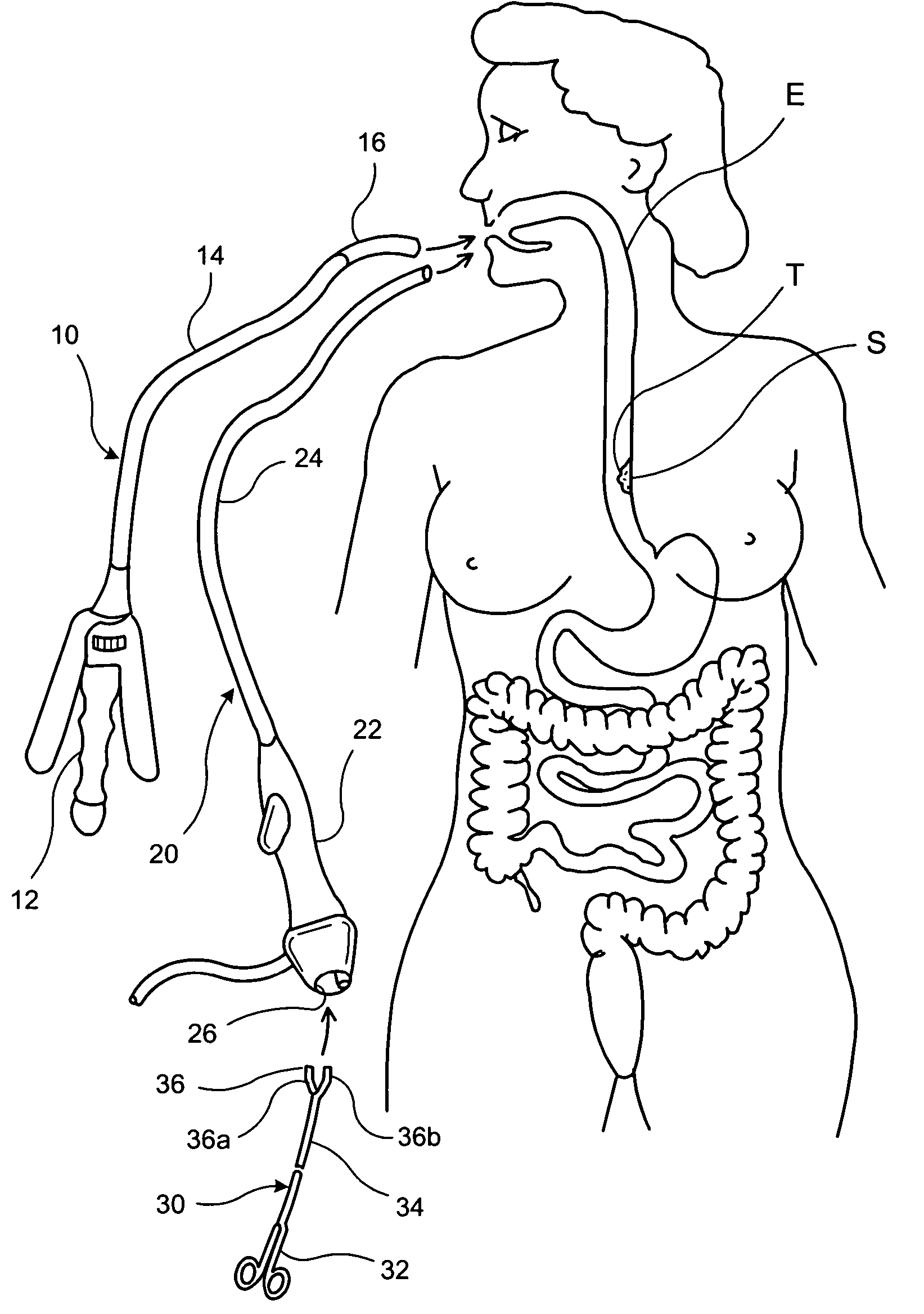 Apparatus and method for resectioning gastro-esophageal tissue