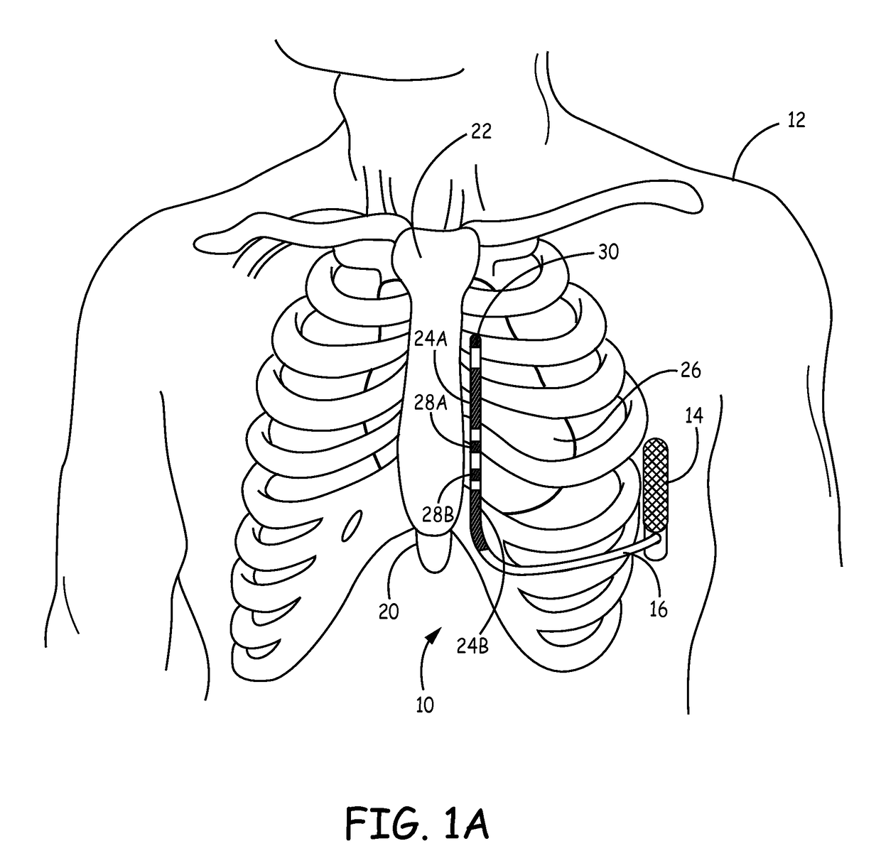 Implantable extravascular electrical stimulation lead having improved sensing and pacing capability