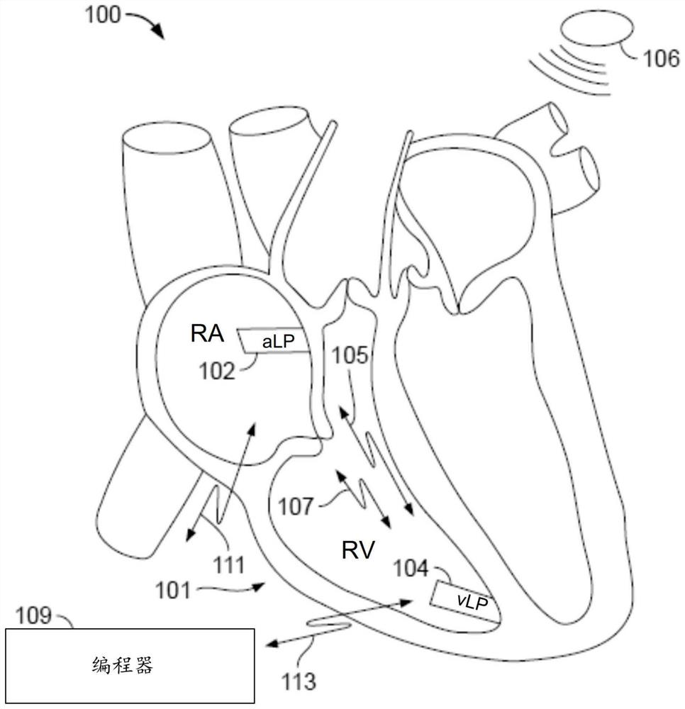 Terminating pacemaker mediated tachycardia (PMT) in dual chamber leadless pacemaker system