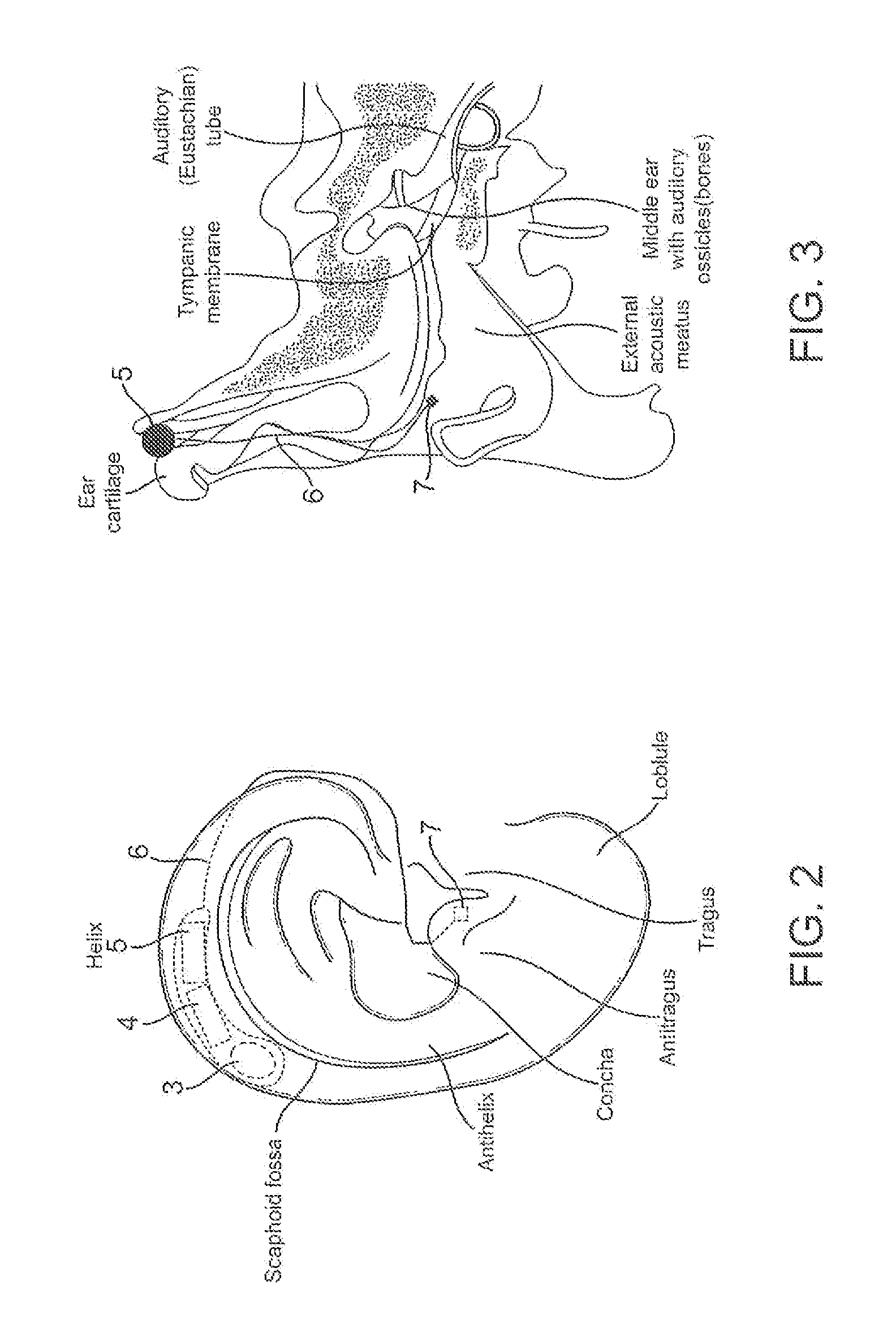 Bone conduction hearing device with open-ear microphone