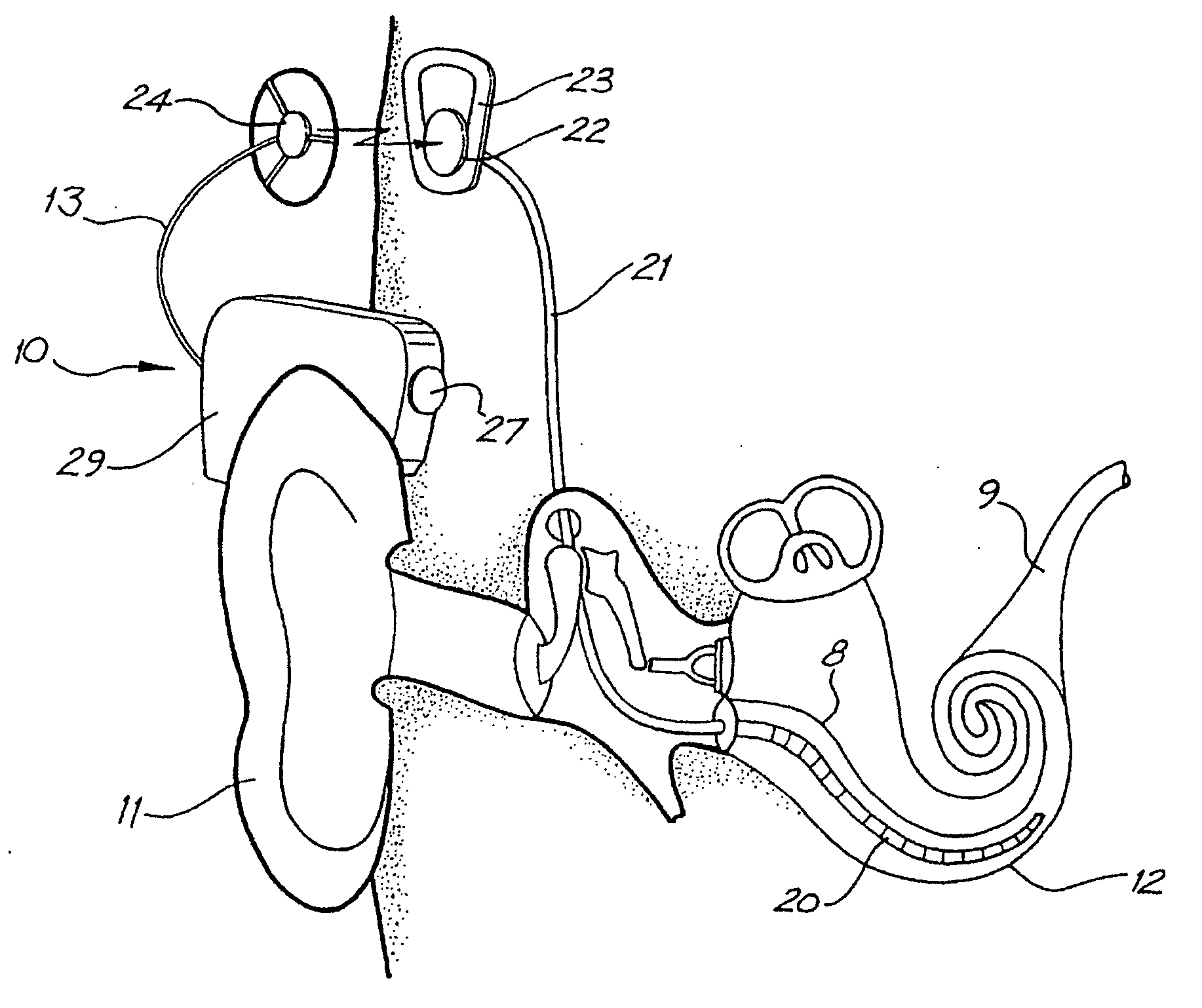 Power supply for a cochlear implant