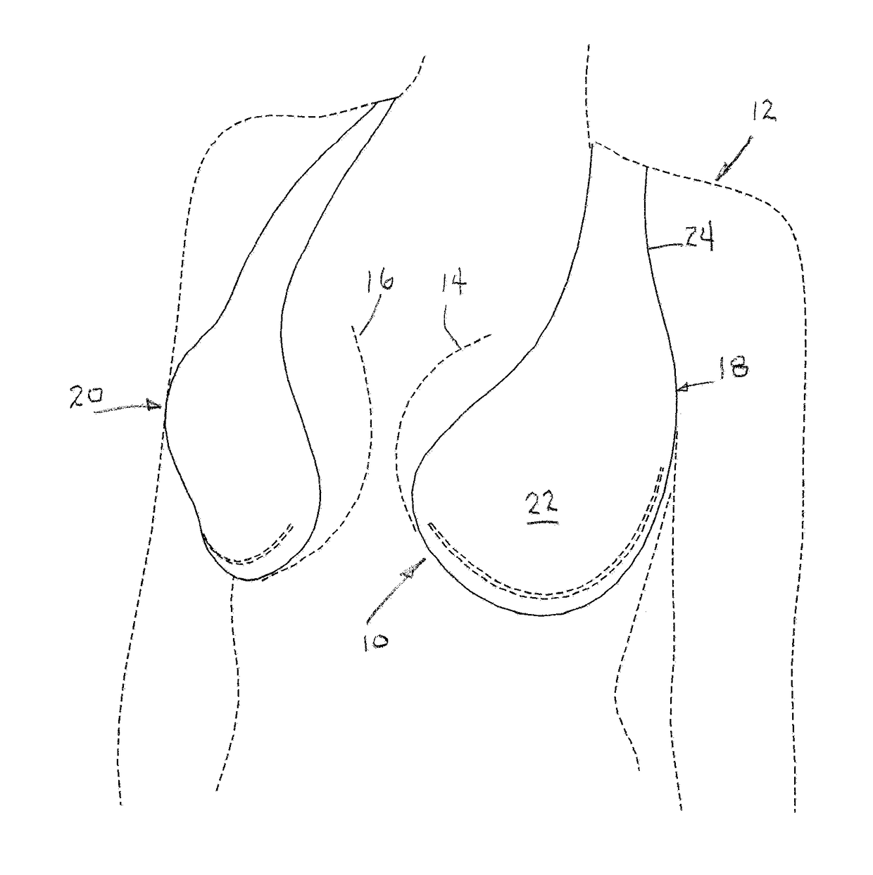 Adhesive Bra Construction Including Vertical Support Strap