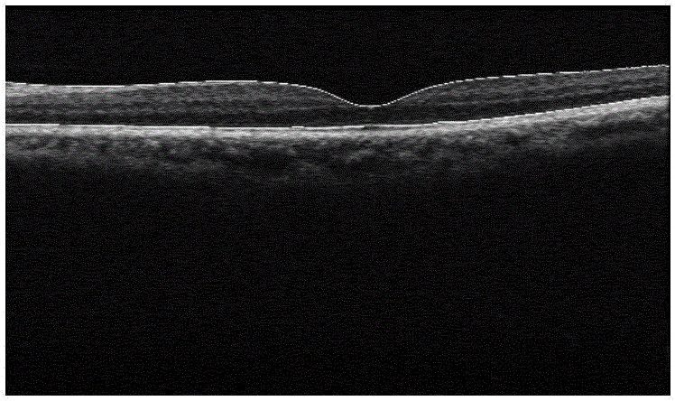 Optical coherent image segmentation method for retina