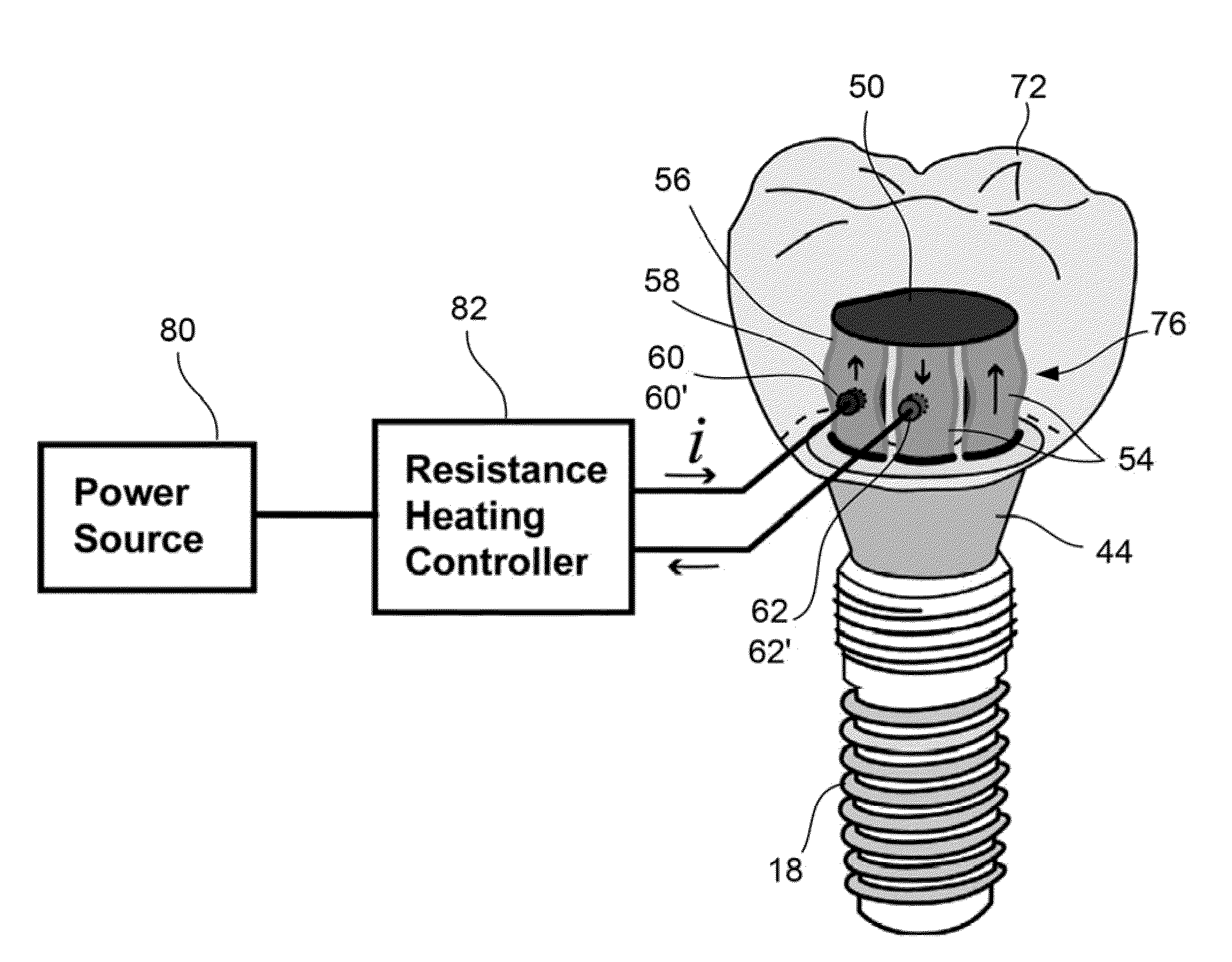 Oral appliance activation devices and methods