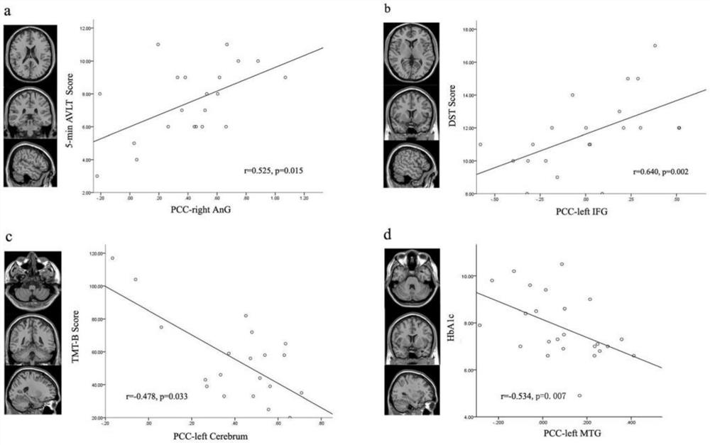 Method for extracting related posterior cingutate function connectivity characteristics of type 2 diabetes patient with cognitive impairment