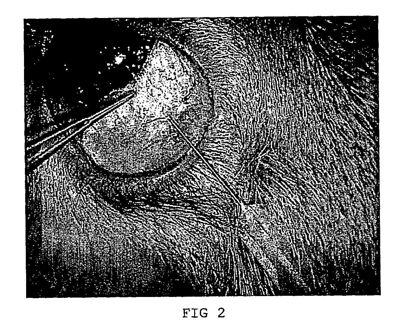 Use of a viscoelastic composition for treating increased intraocular pressure