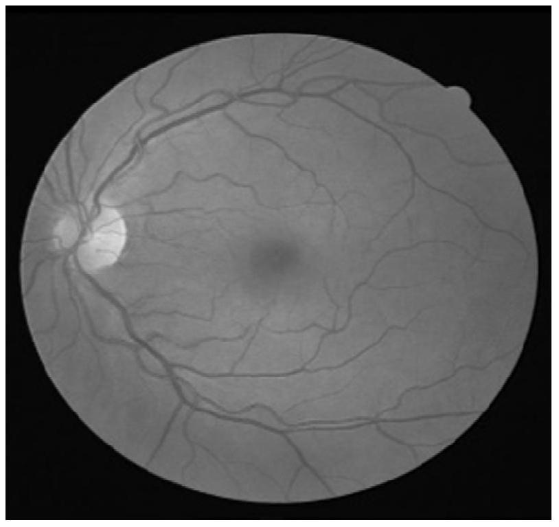 Retinal vessel segmentation method combining U-Net and adaptive PCNN