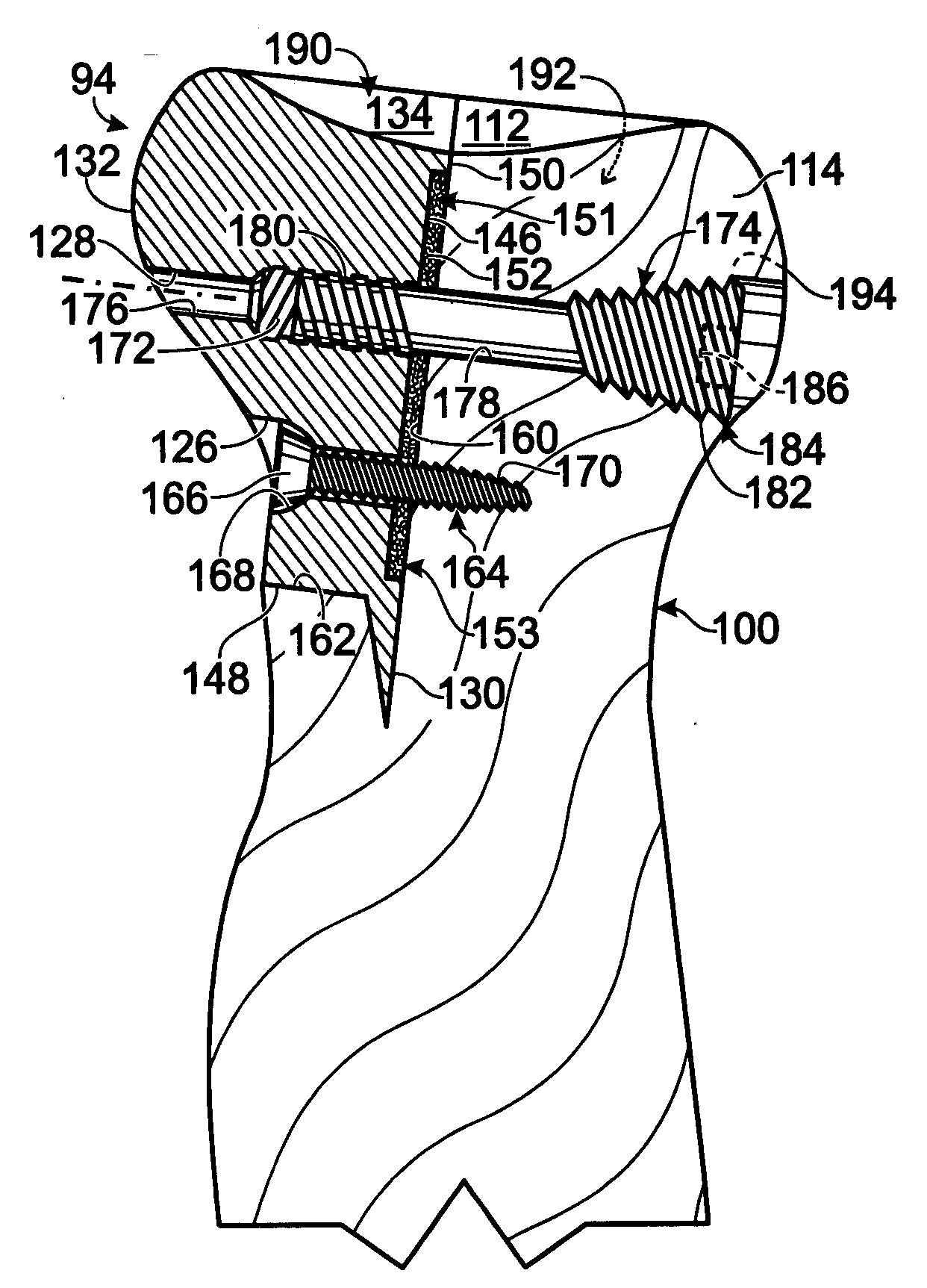 Prosthesis for partial replacement of an articulating surface on bone