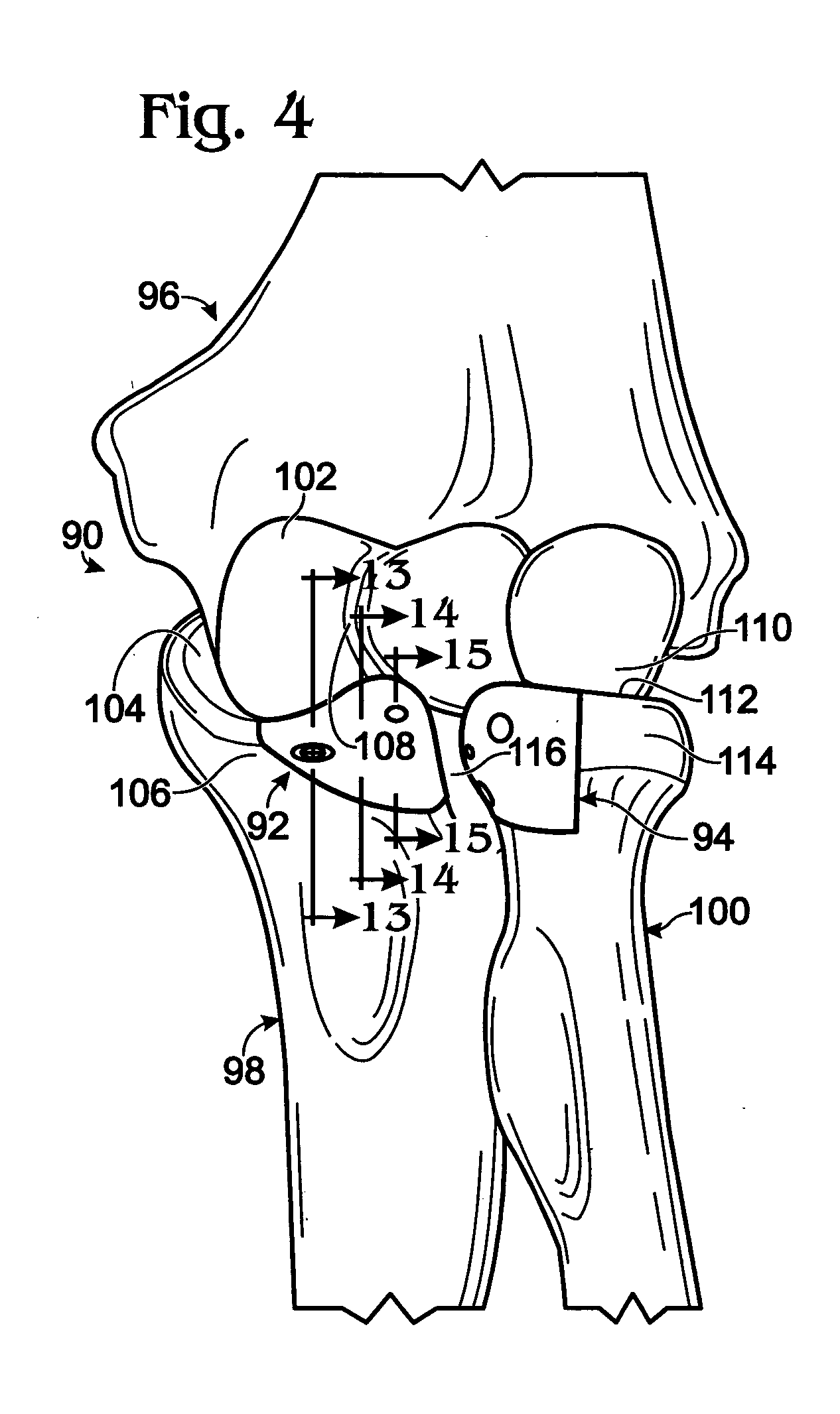 Prosthesis for partial replacement of an articulating surface on bone