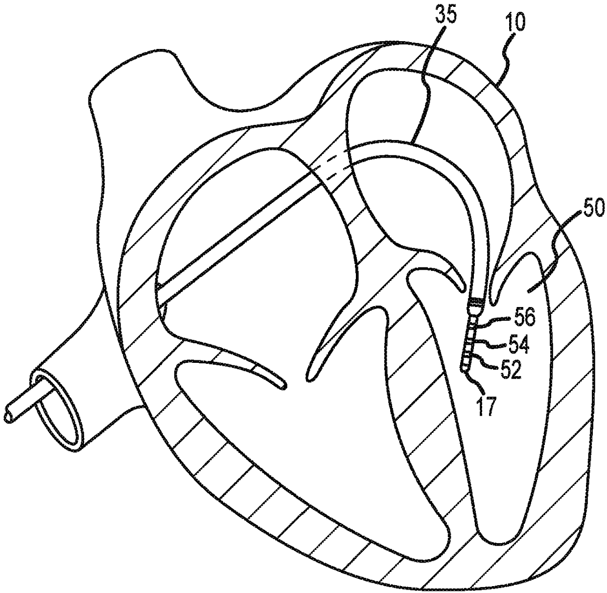 System and method for electrophysiology procedures