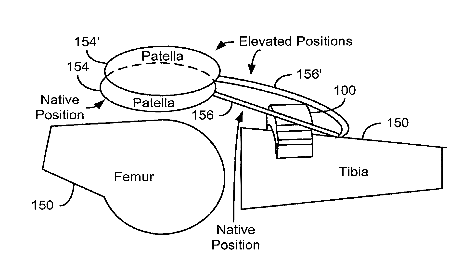 Method and System for Patella Tendon Realignment