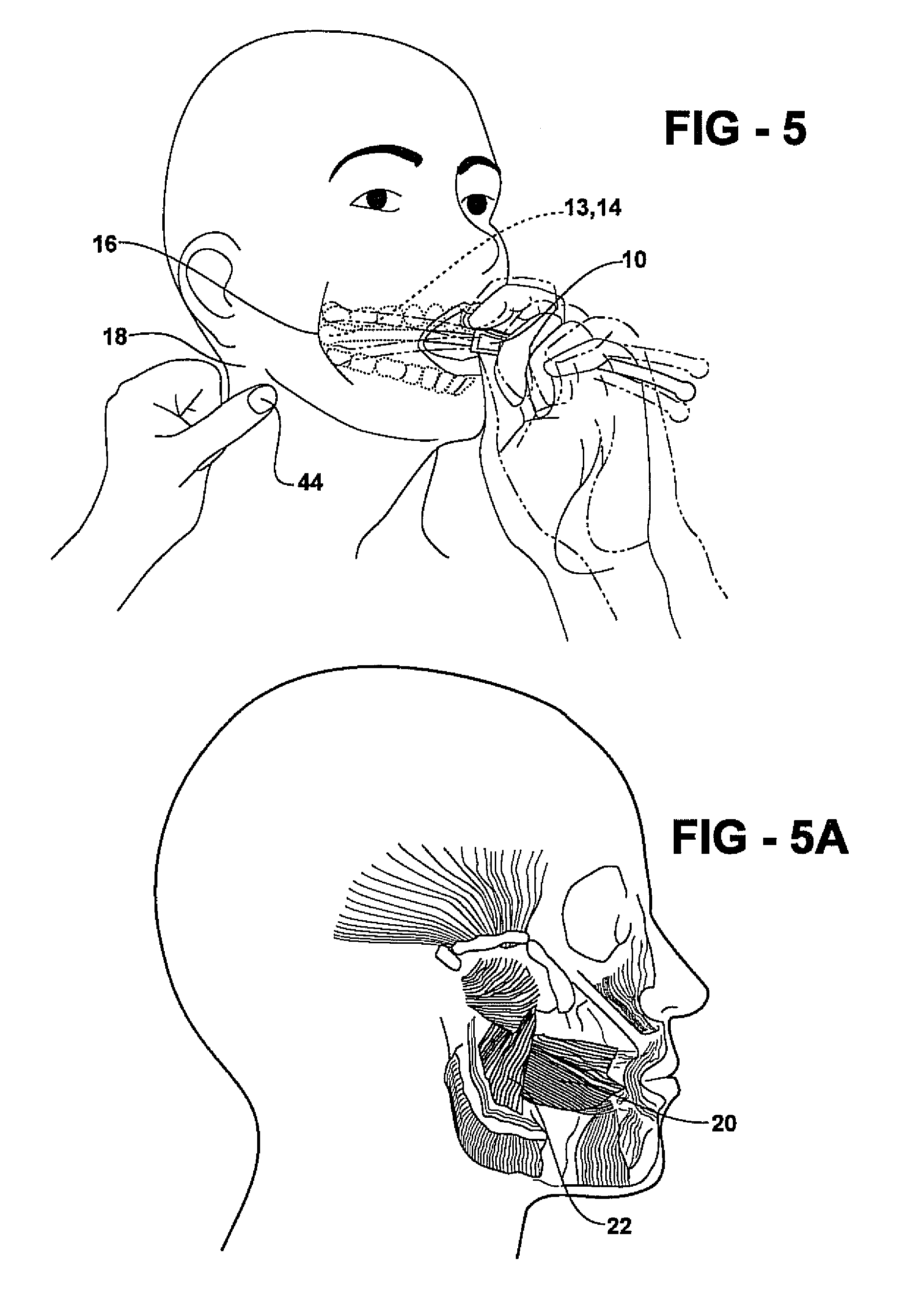 Method and apparatus for intra oral myofascial trigger point therapy