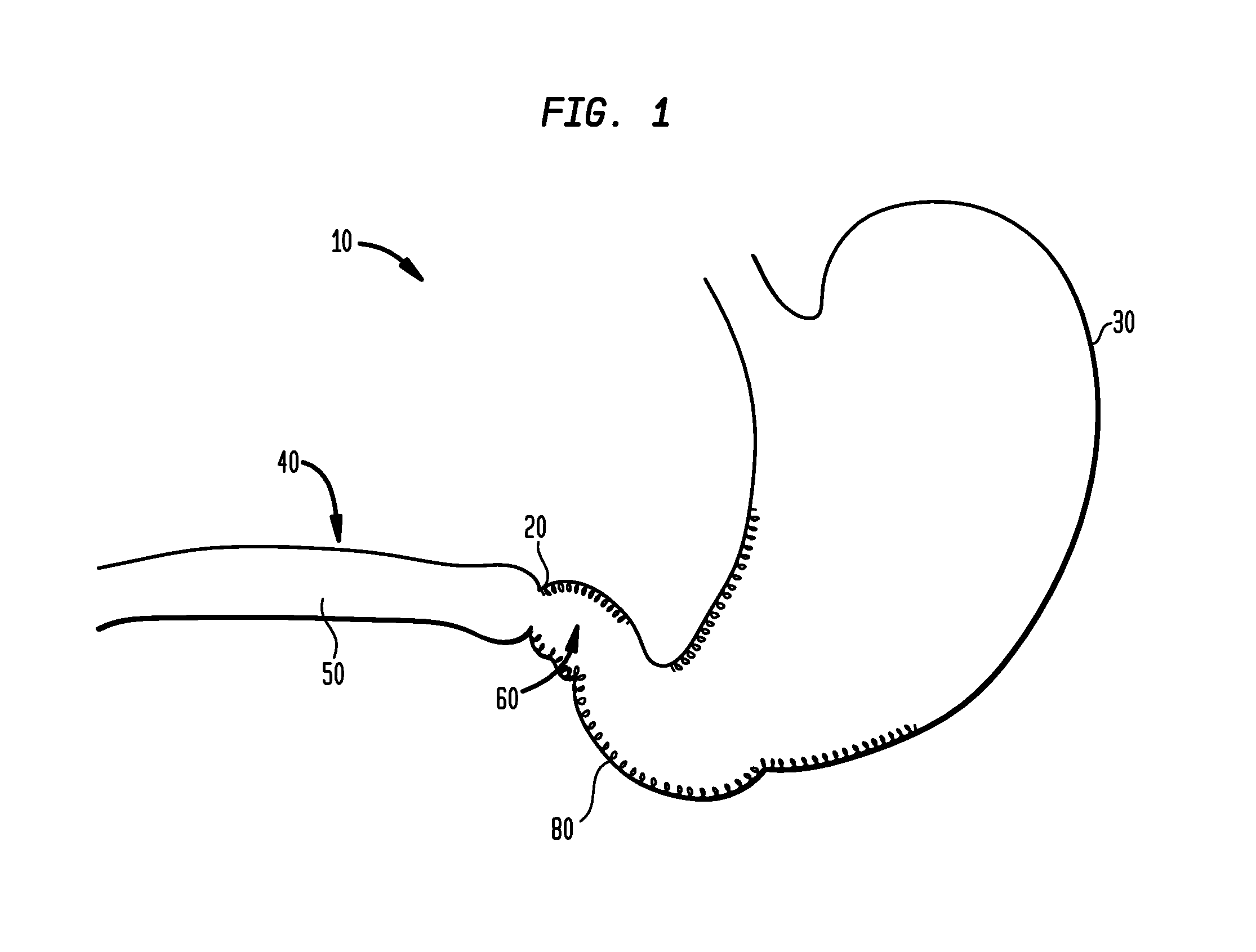 Systems and methods for treatment of obesity and type 2 diabetes