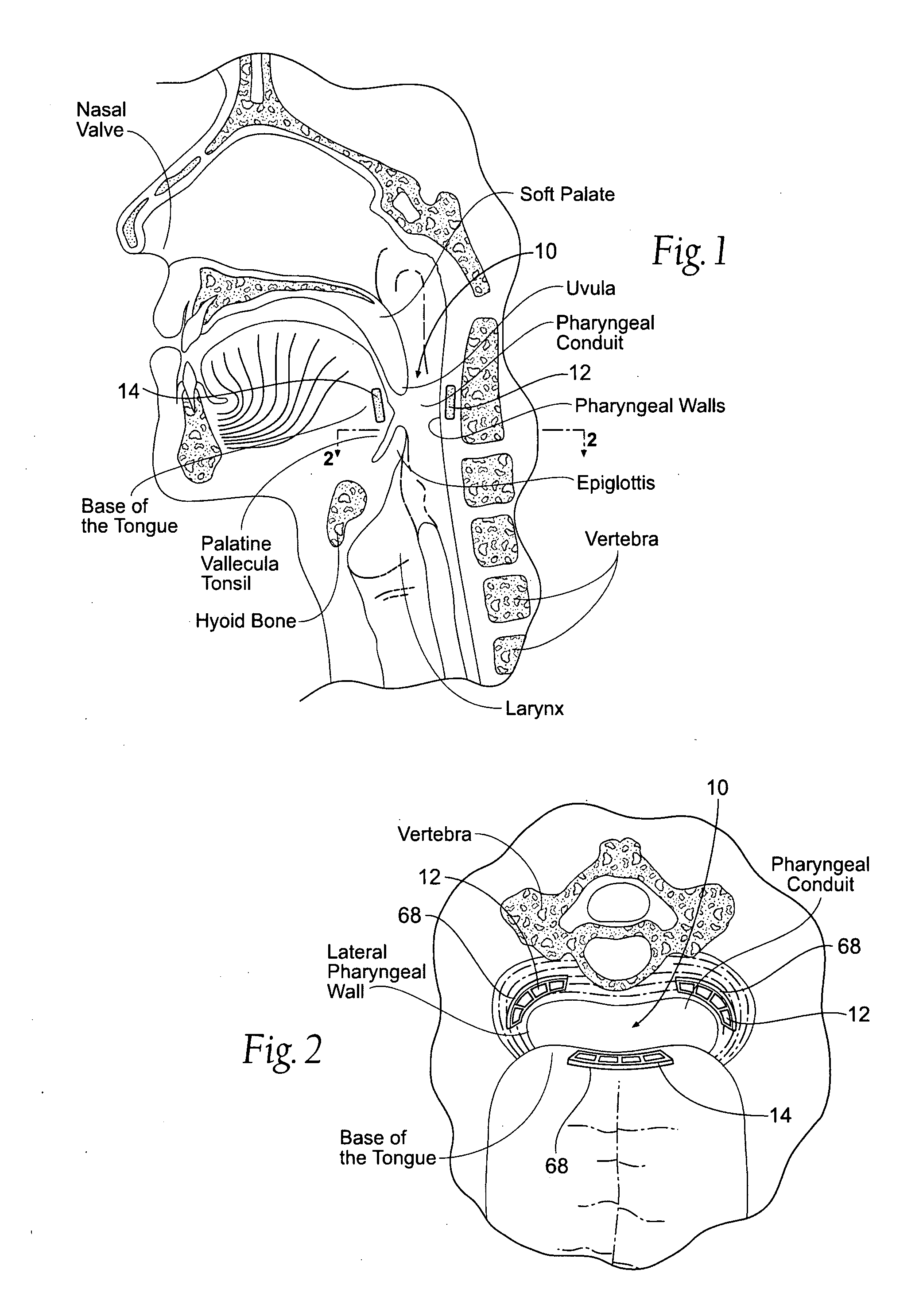 Devices, systems, and methods to fixate tissue within the regions of the body, such as the pharyngeal conduit
