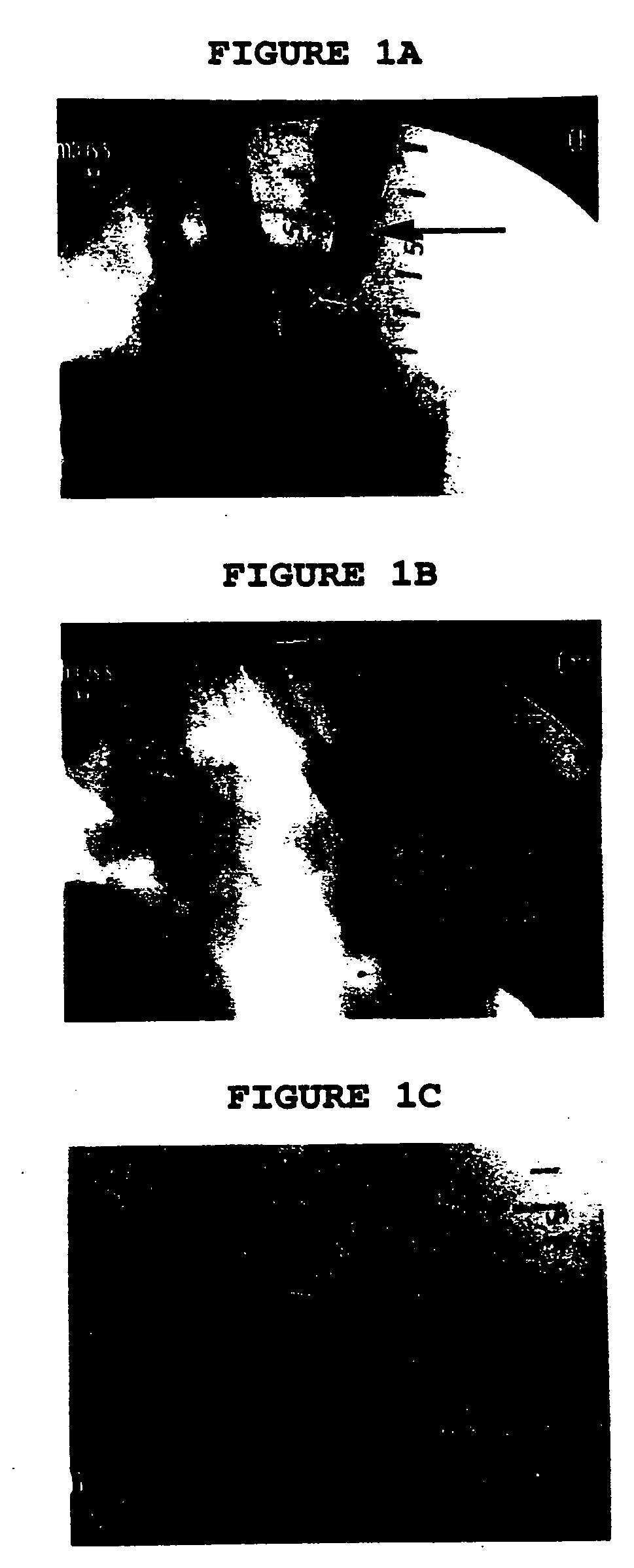 Method for treatment of indwelling catheter occlusion using fibrinolytic metalloproteinases