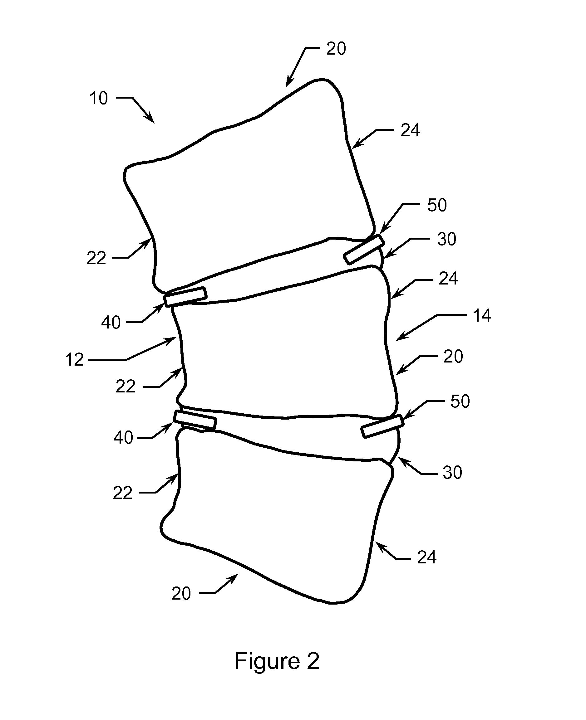 Method of Treating Scoliosis Using a Biological Implant