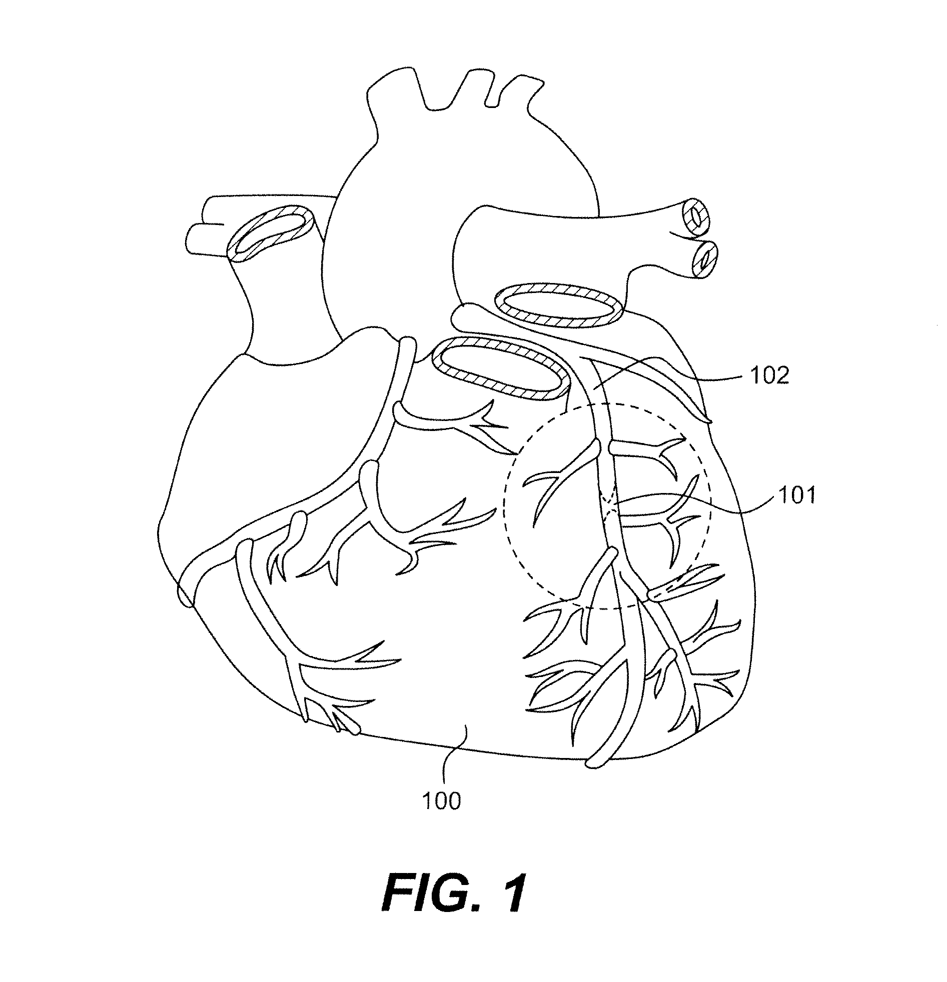 Endovascular devices and methods